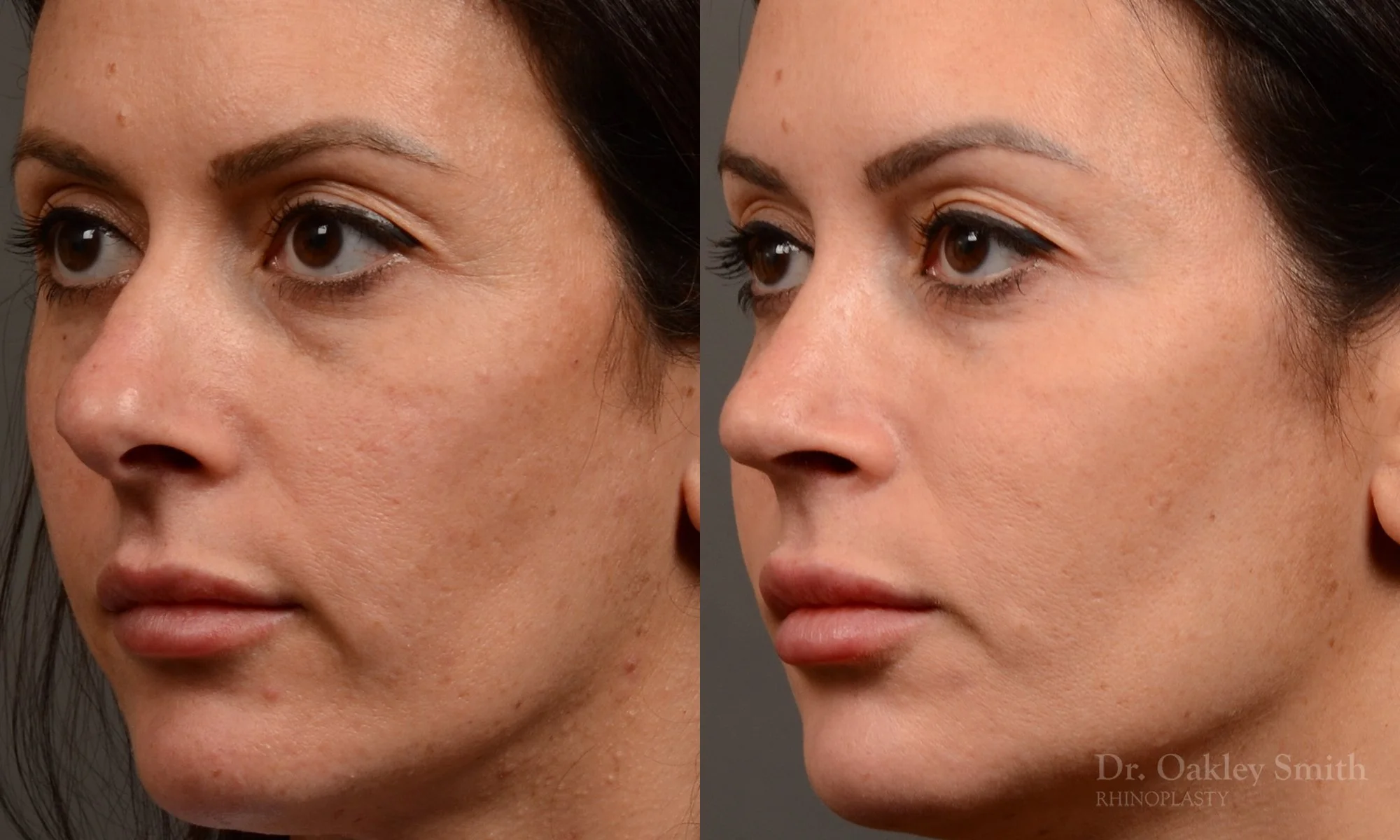 495D-rhinoplasty-dr-oakley-smith-toronto-top-surgeon-nose-job.jpg