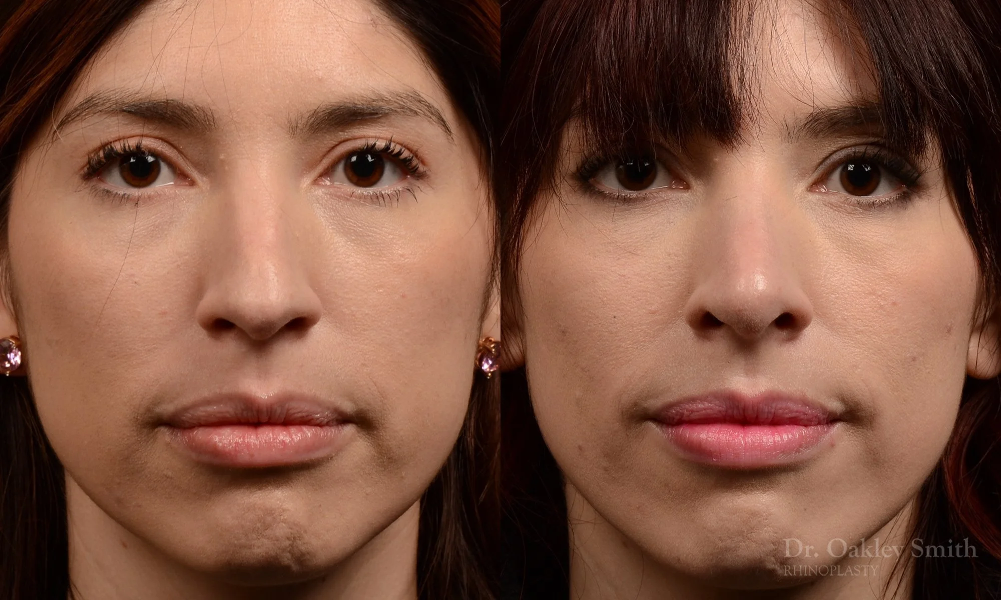 525A-rhinoplasty-dr-oakley-smith-toronto-top-surgeon-nose-job.jpg