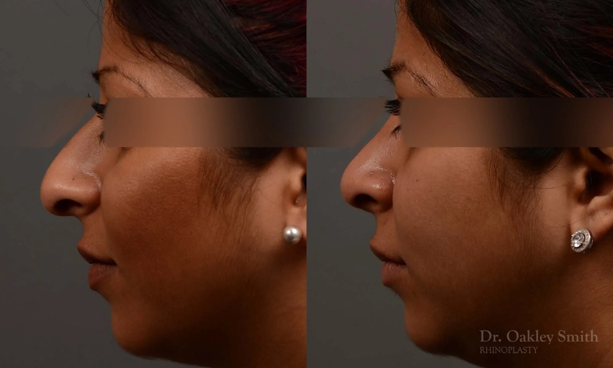 346E-rhinoplasty-dr-oakley-smith-toronto-nose-job.jpg