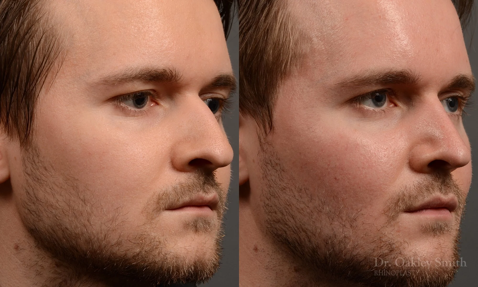 401B-expert-rhinoplasty-surgeon-rhinoplasty-dr-oakley-smith-toronto-nose-job-surgery.jpg