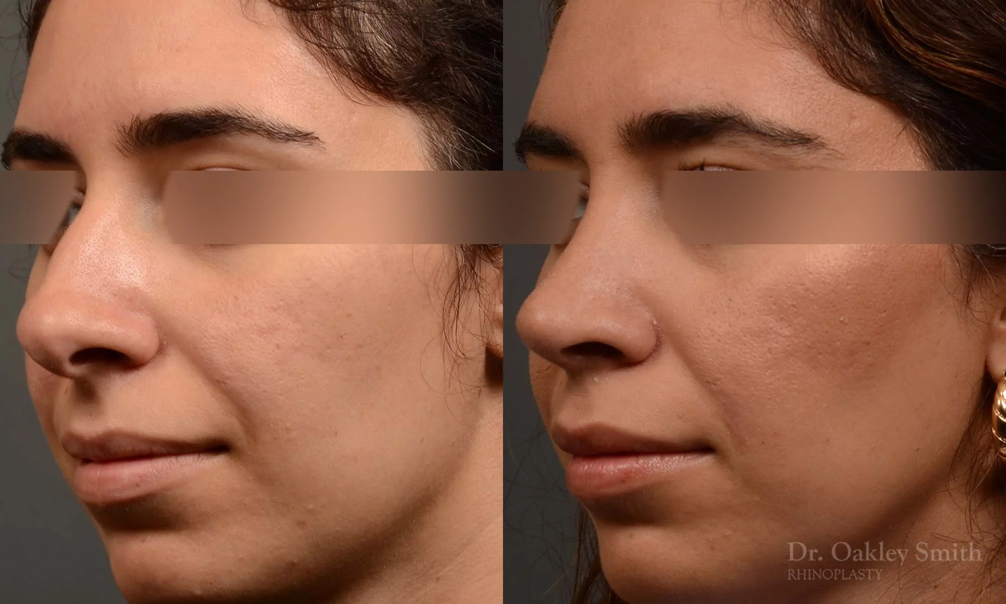 488D-rrhinoplasty-dr-oakley-smith-toronto-top-surgeon-nose-job.jpg