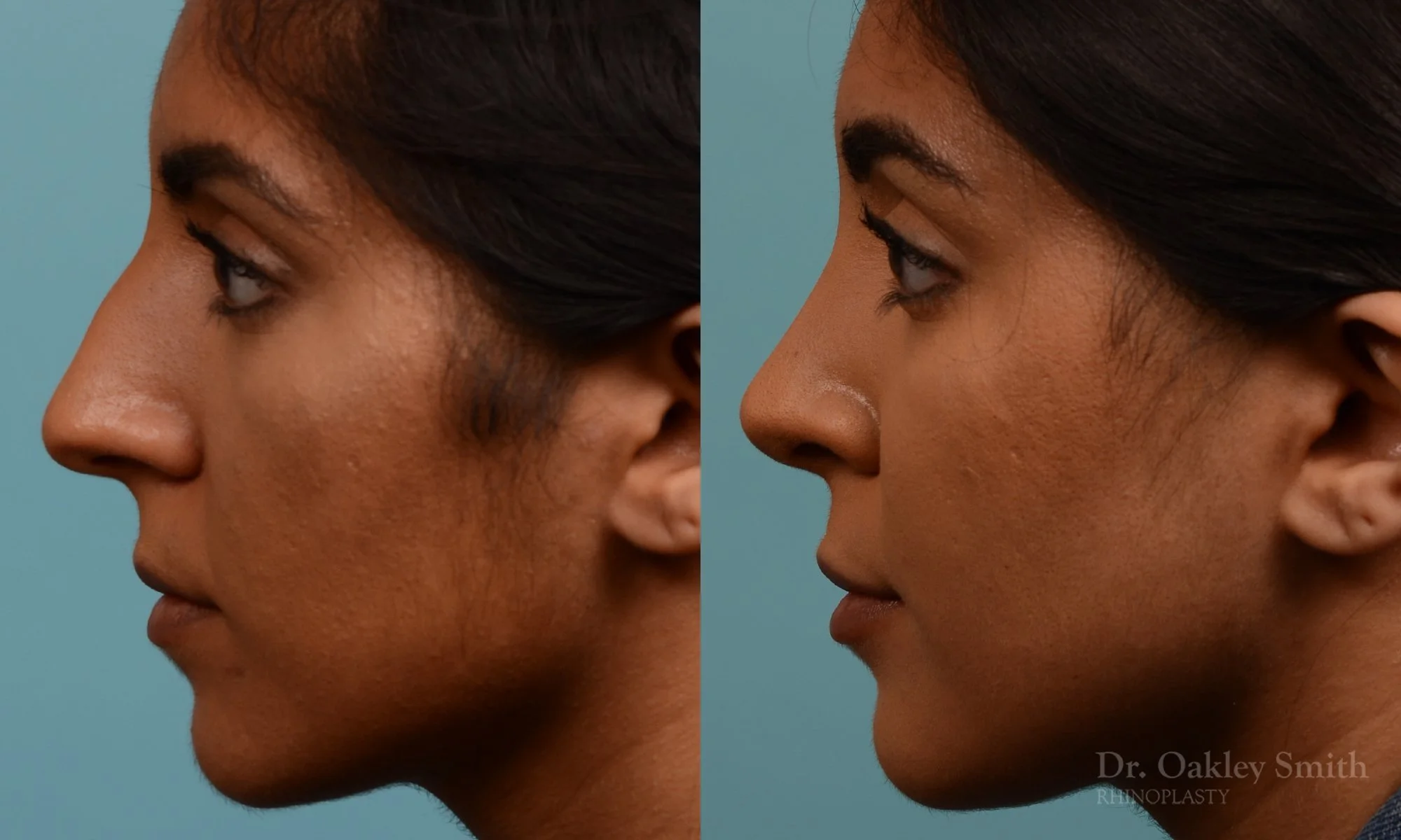 303.1E-rhinoplasty-dr-oakley-smith-toronto-nose-job.jpg