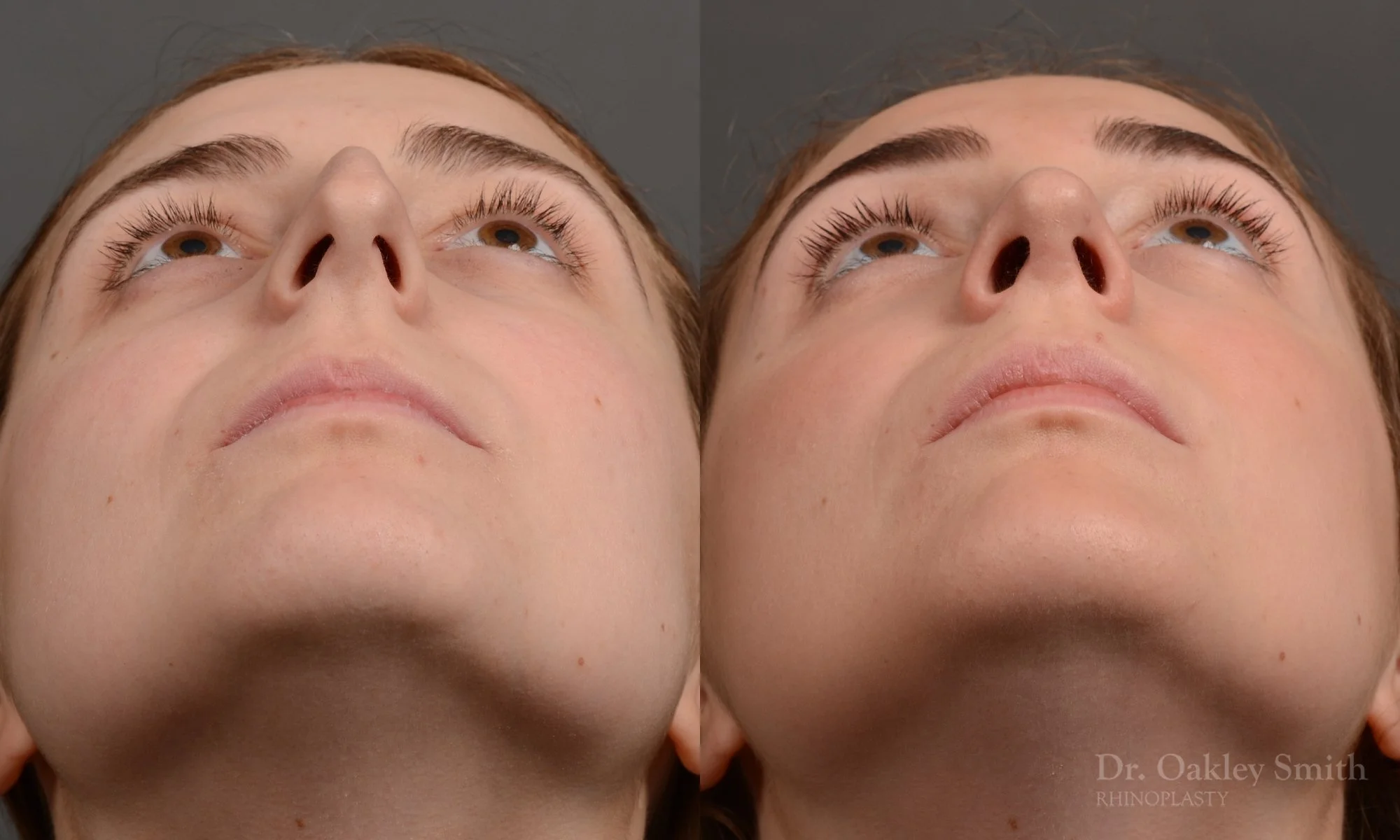 305.1F-rhinoplasty-dr-oakley-smith-toronto-nose-job.jpg