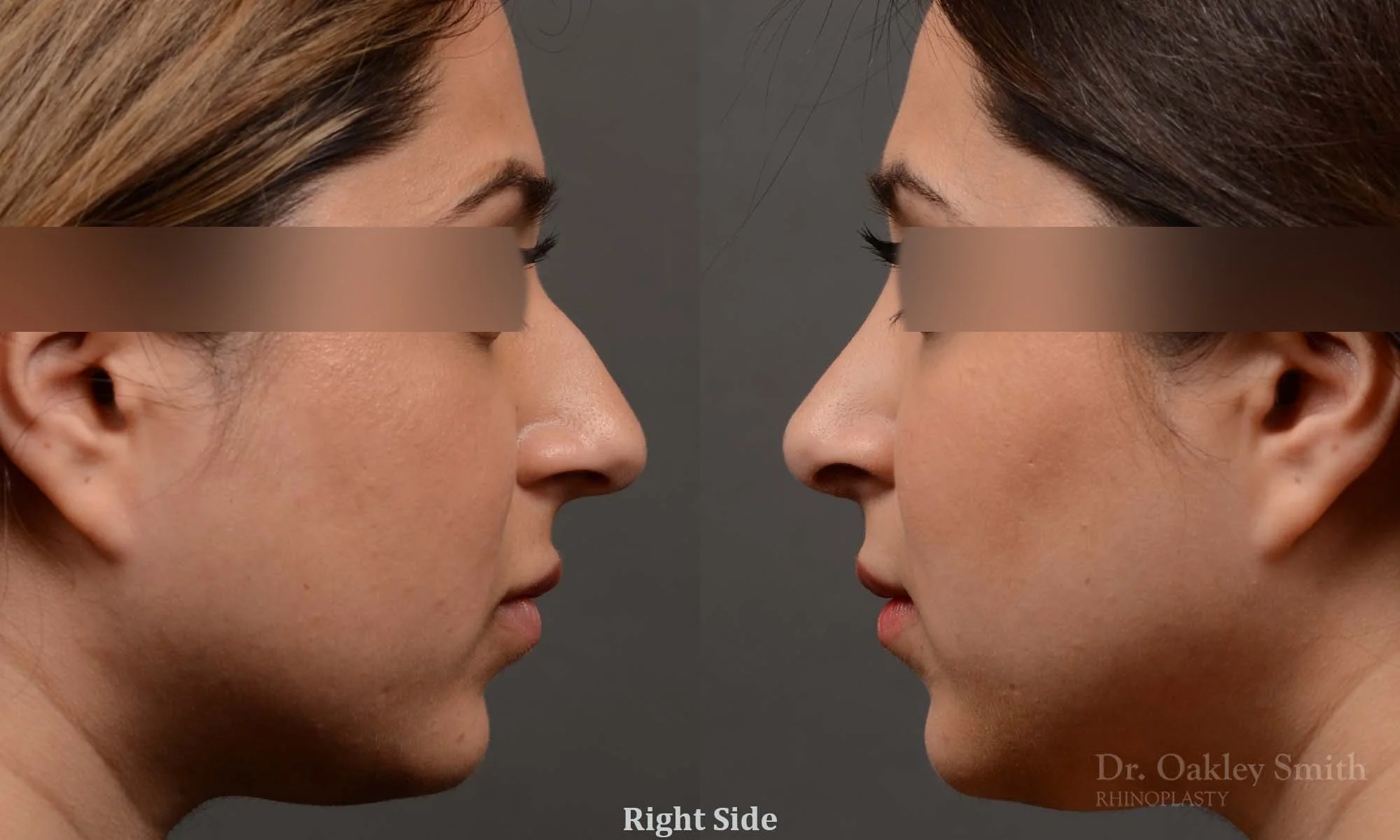 333C-rhinoplasty-dr-oakley-smith-toronto-nose-job.jpg