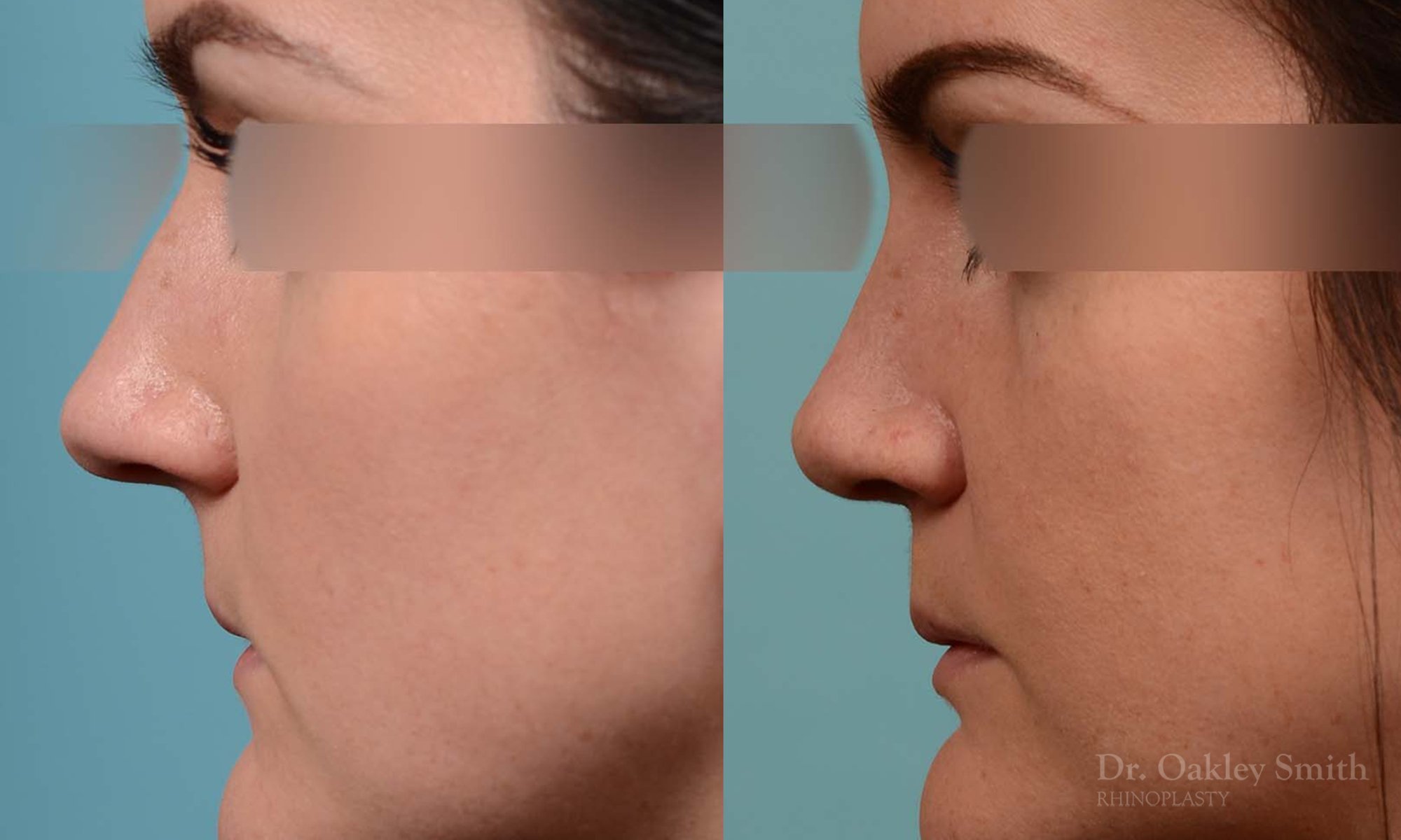 252E-rhinoplasty-dr-oakley-smith-toronto-nose-job.jpg
