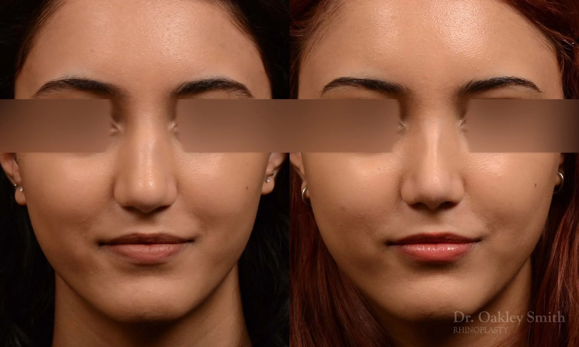 533A-hinoplasty-dr-oakley-smith-toronto-top-surgeon-nose-job.jpg