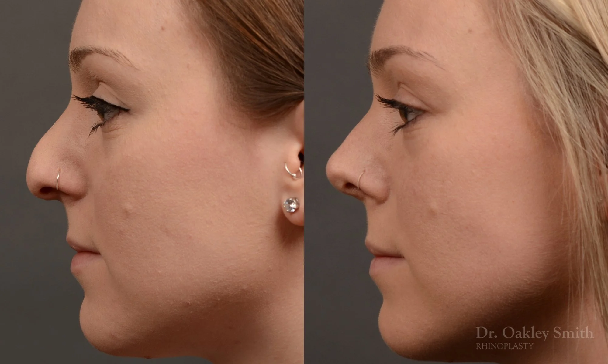 477E-rhinoplasty-dr-oakley-smith-toronto-top-surgeon-nose-job.jpg