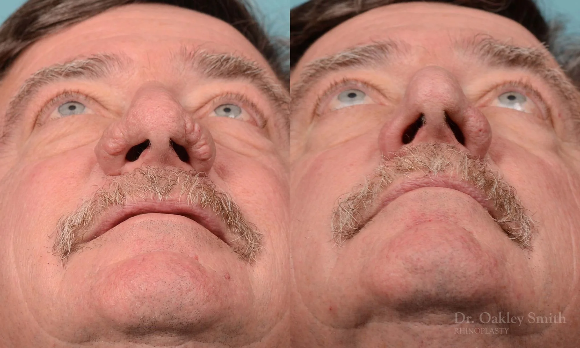 210F-rhinoplasty-rhinophyma-elderly-man-dr-oakley-smith-toronto-nose-reduction-1.jpg