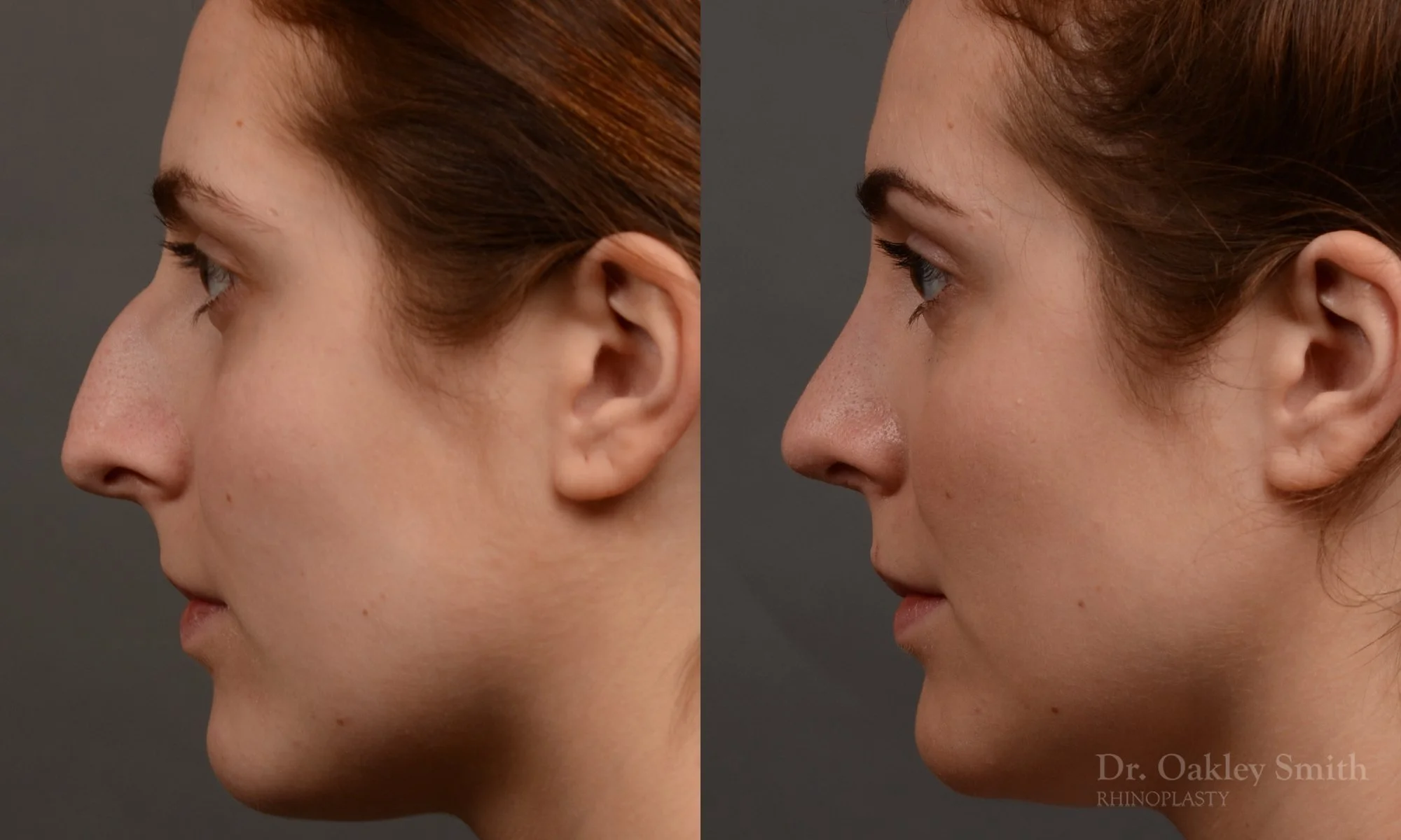 305.1E-rhinoplasty-dr-oakley-smith-toronto-nose-job.jpg