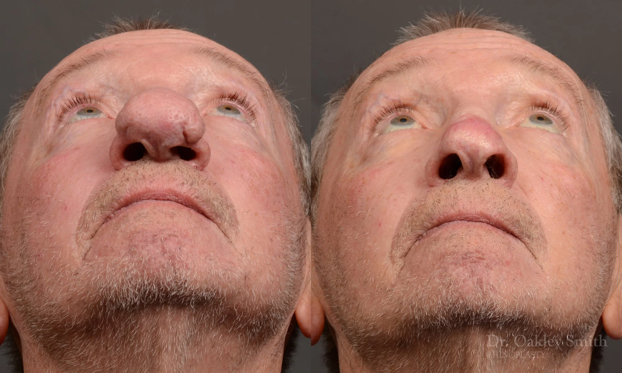 548F-Rhinophyma-nose-job-growth-toronto-nose-surgeon-dr.-oakley-smith.jpg
