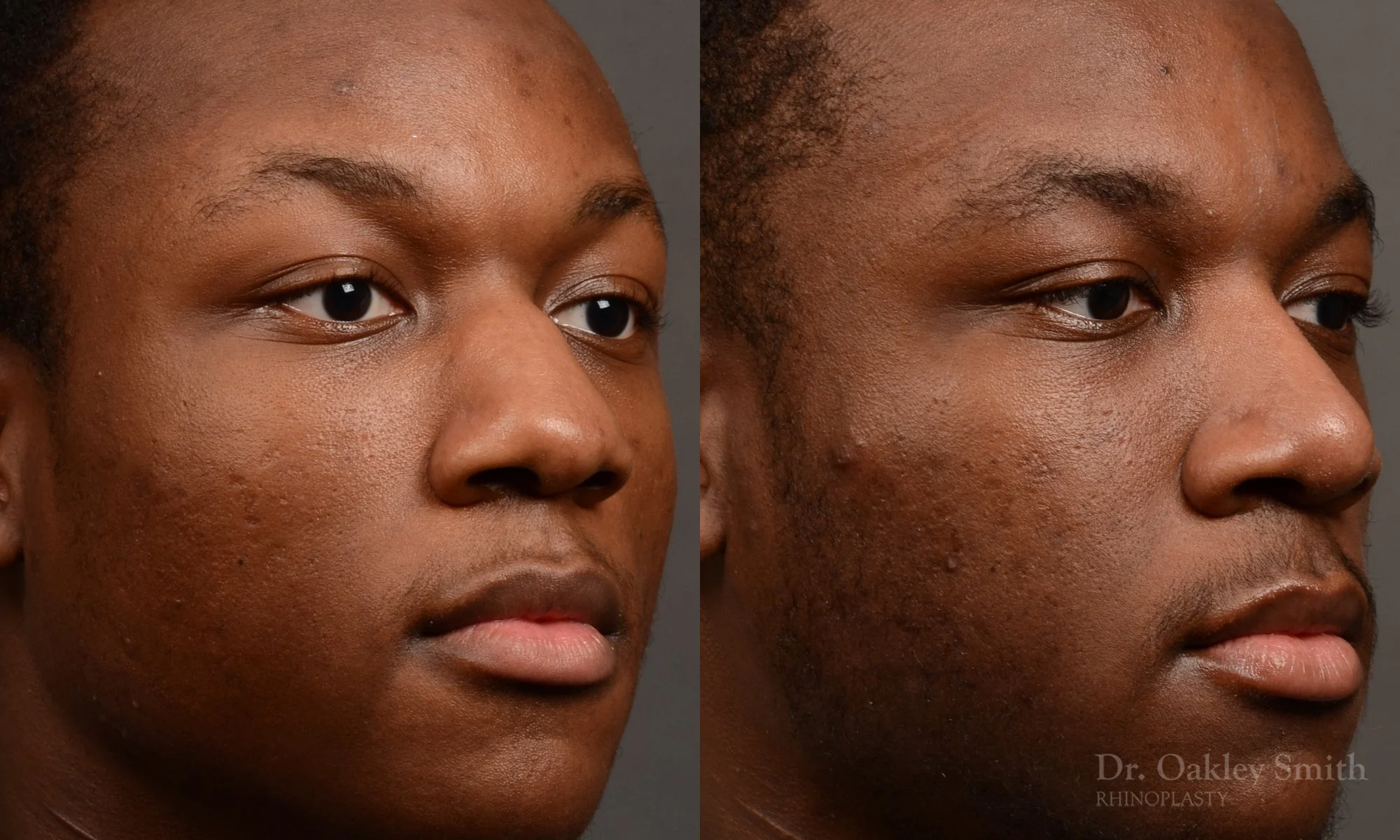 515B-male-rhinoplasty-dr-oakley-smith-toronto-top-surgeon-nose-job (1).jpg