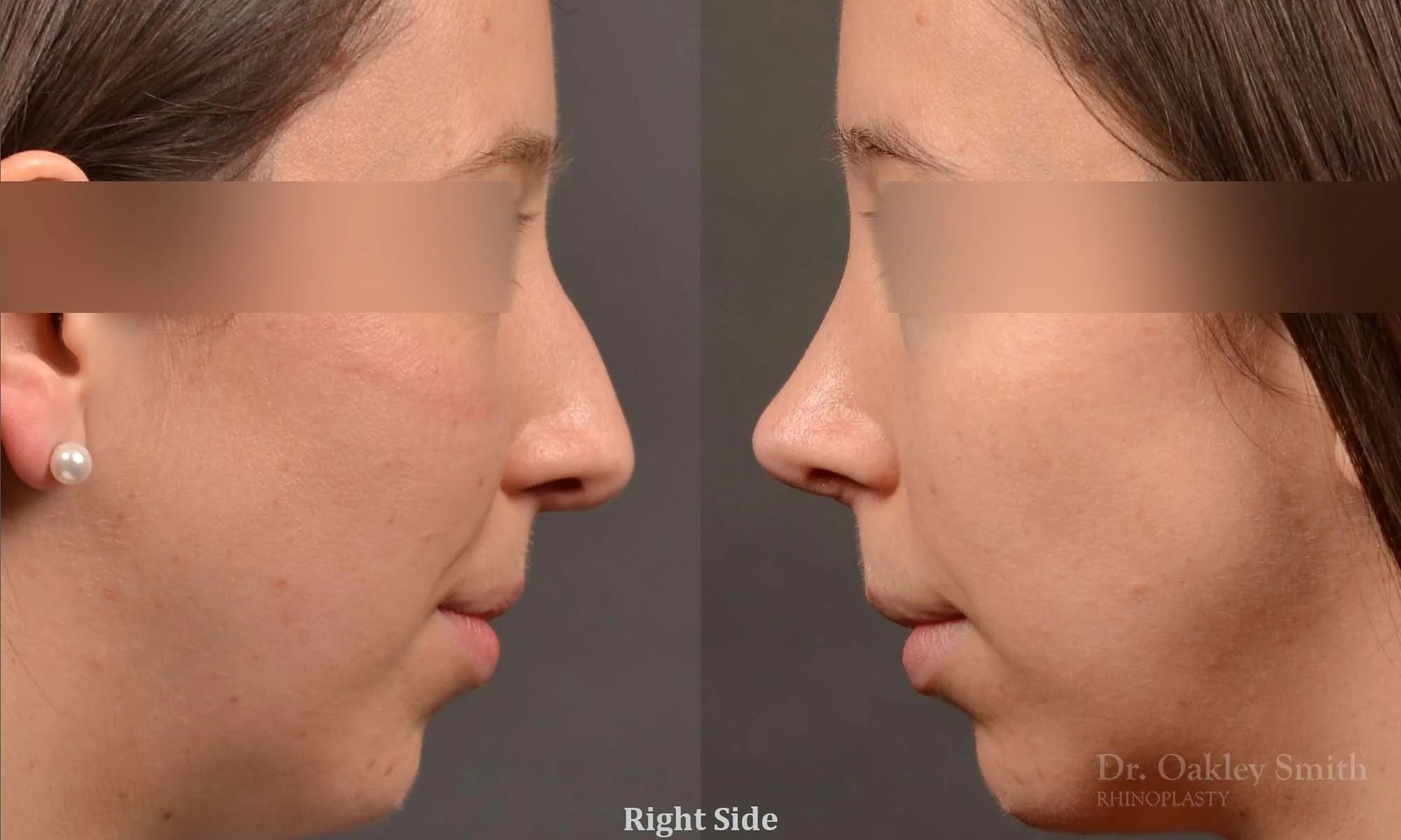 534: Female, Primary Rhinoplasty, Thin Skin, Bridge Work, Tip Work