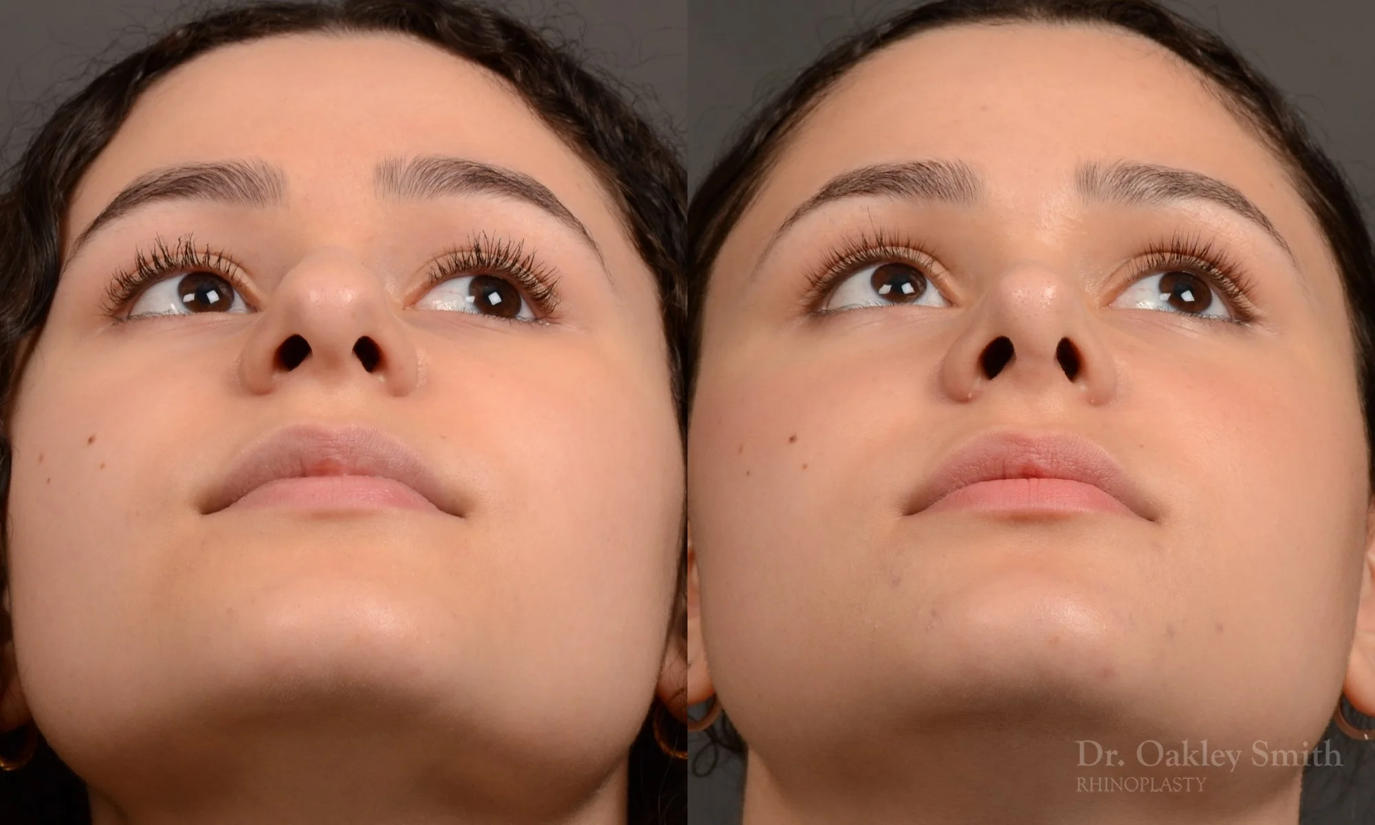 543F-rhinoplasty-before-and-after-nose-job-toronto-Dr.-Oakley-Smith.jpg.jpg