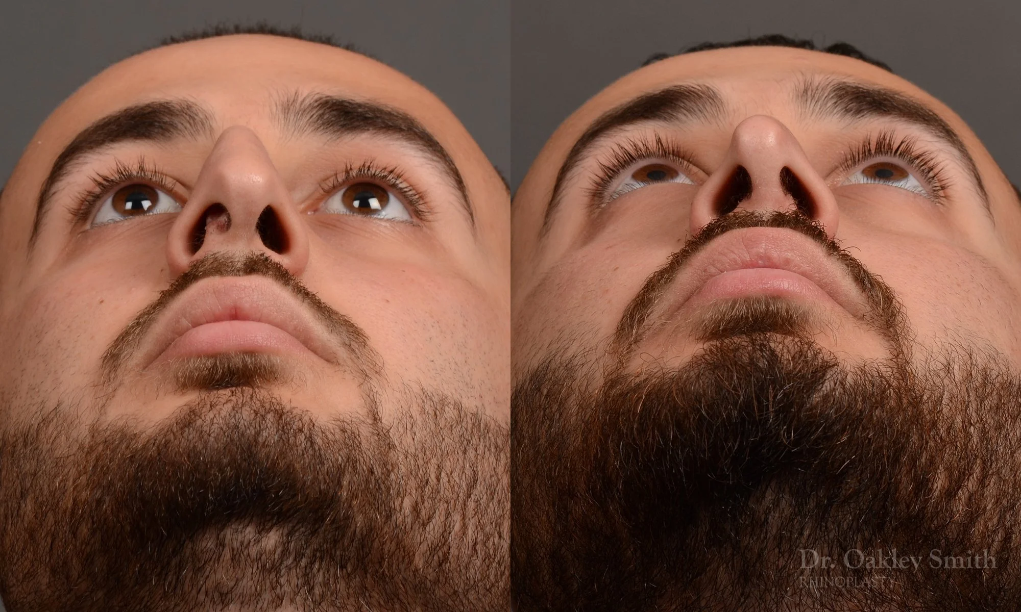 391F-rhinoplasty-dr-oakley-smith-toronto-nose-job.jpg