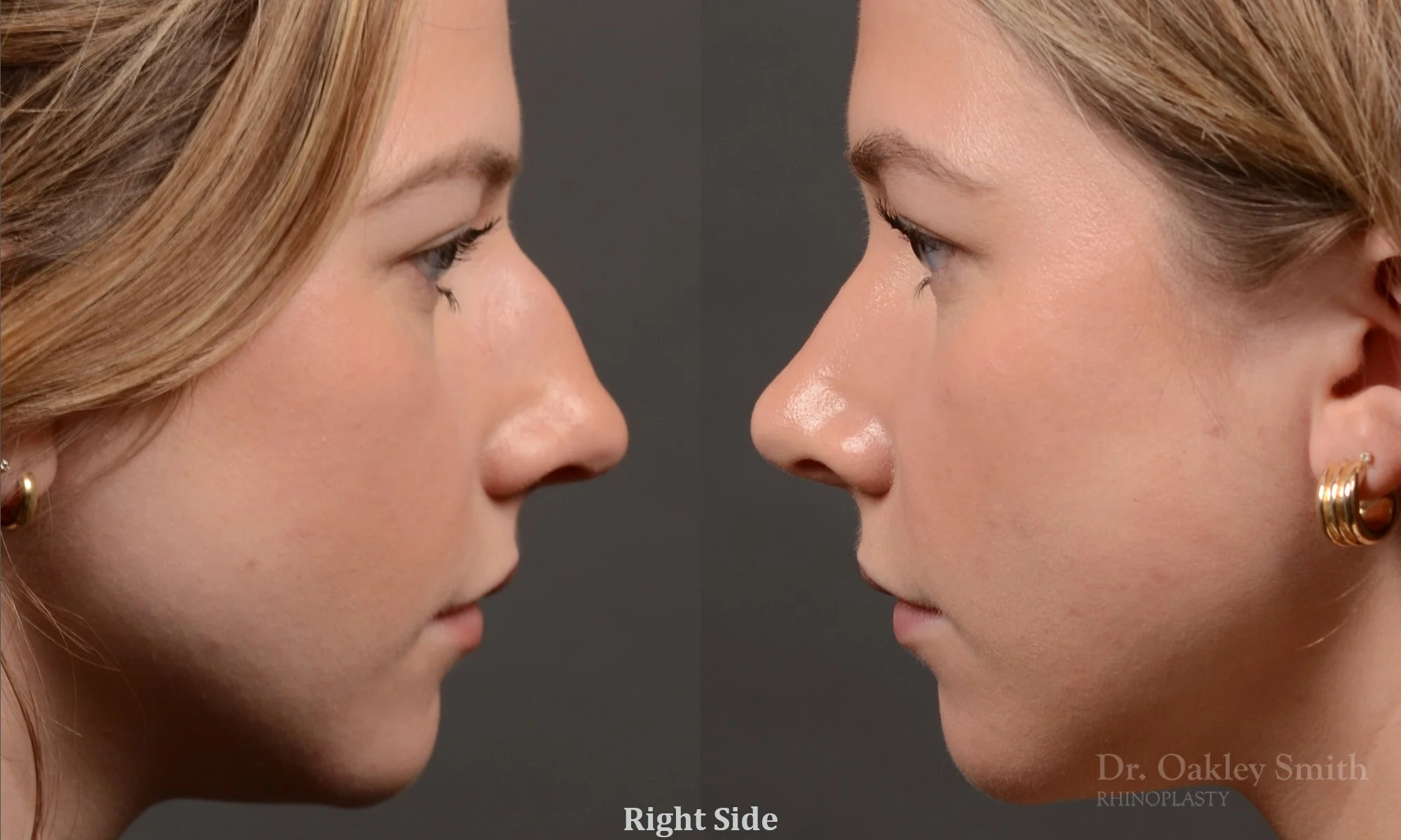 536: Female, Primary Rhinoplasty, Dorsal Hump, Bulbous Tip