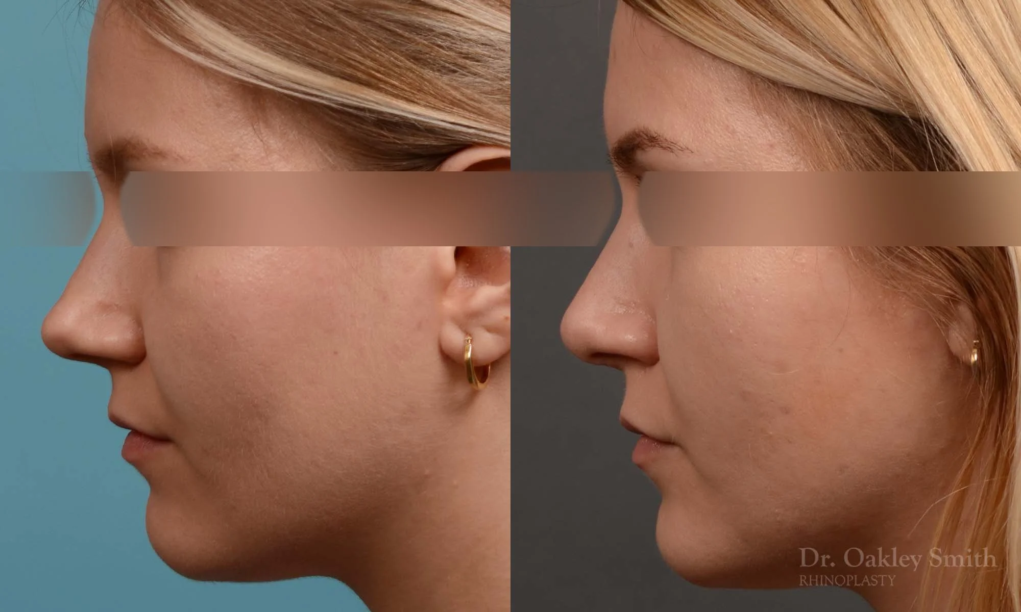 292E-rhinoplasty-dr-oakley-smith-toronto-nose-job.jpg