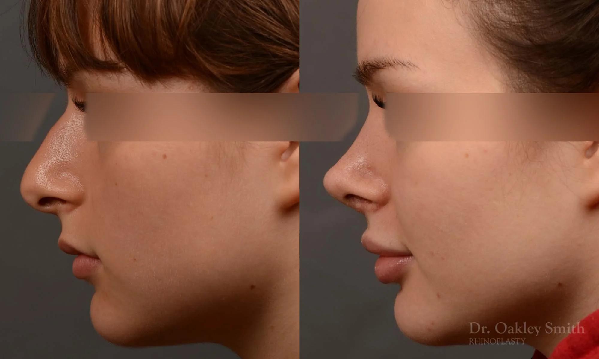 530E-rhinoplasty-dr-oakley-smith-toronto-top-surgeon-nose-job.jpg