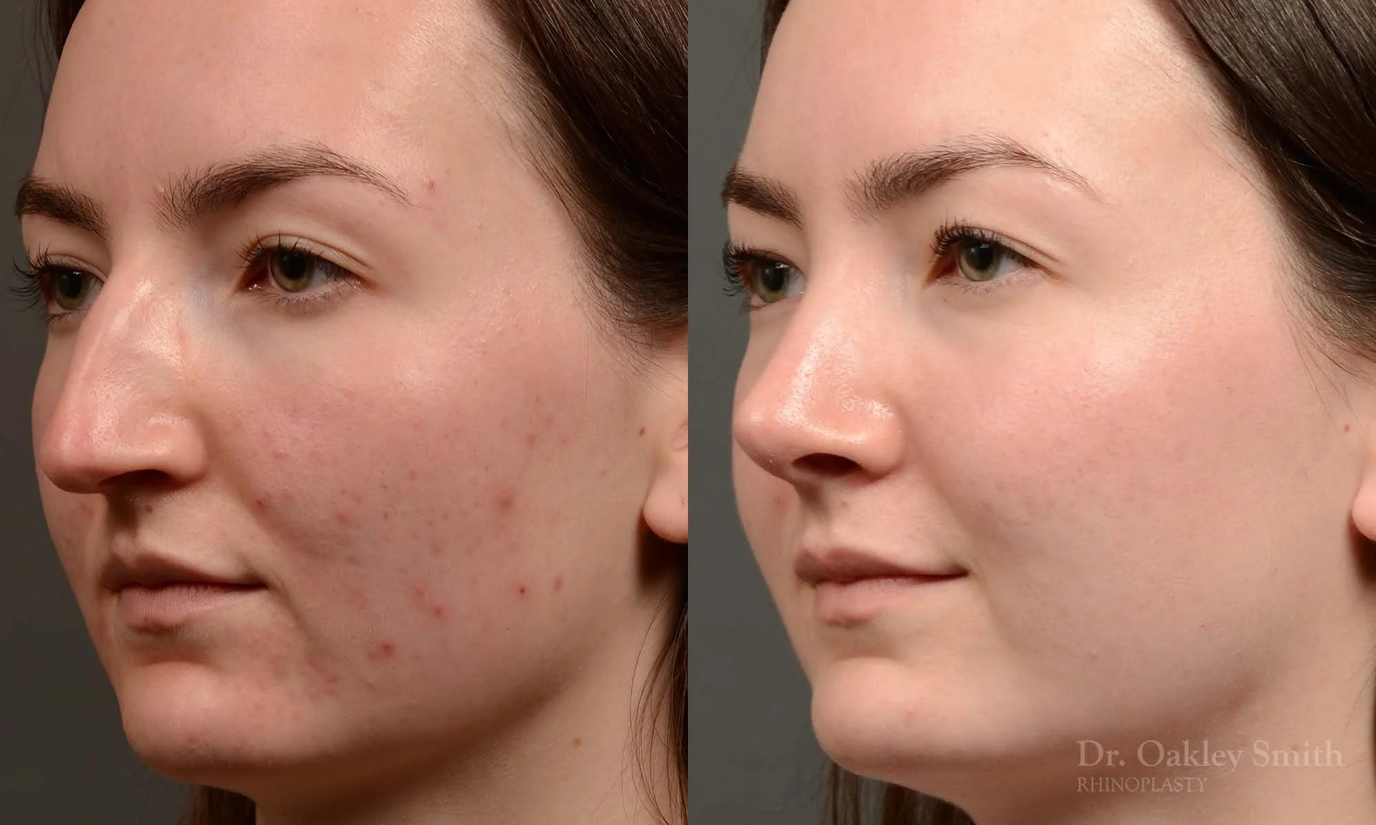 Case 601 Dr. Oakley Smith, preservation rhinoplasty, 12 months after surgery, left oblique view
