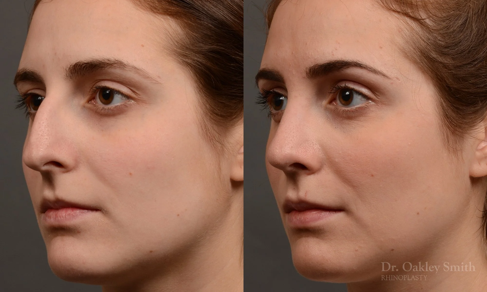 305.1D-rhinoplasty-dr-oakley-smith-toronto-nose-job.jpg