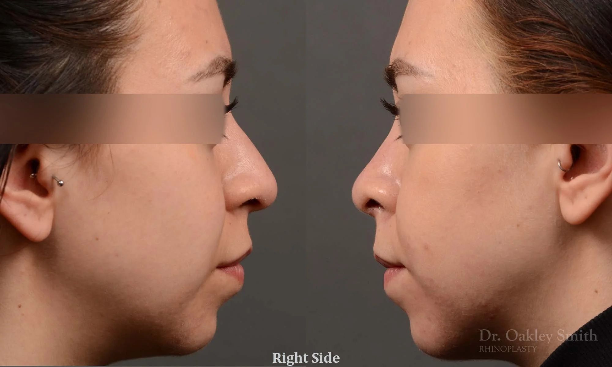 342C-rhinoplasty-dr-oakley-smith-toronto-nose-job.jpg