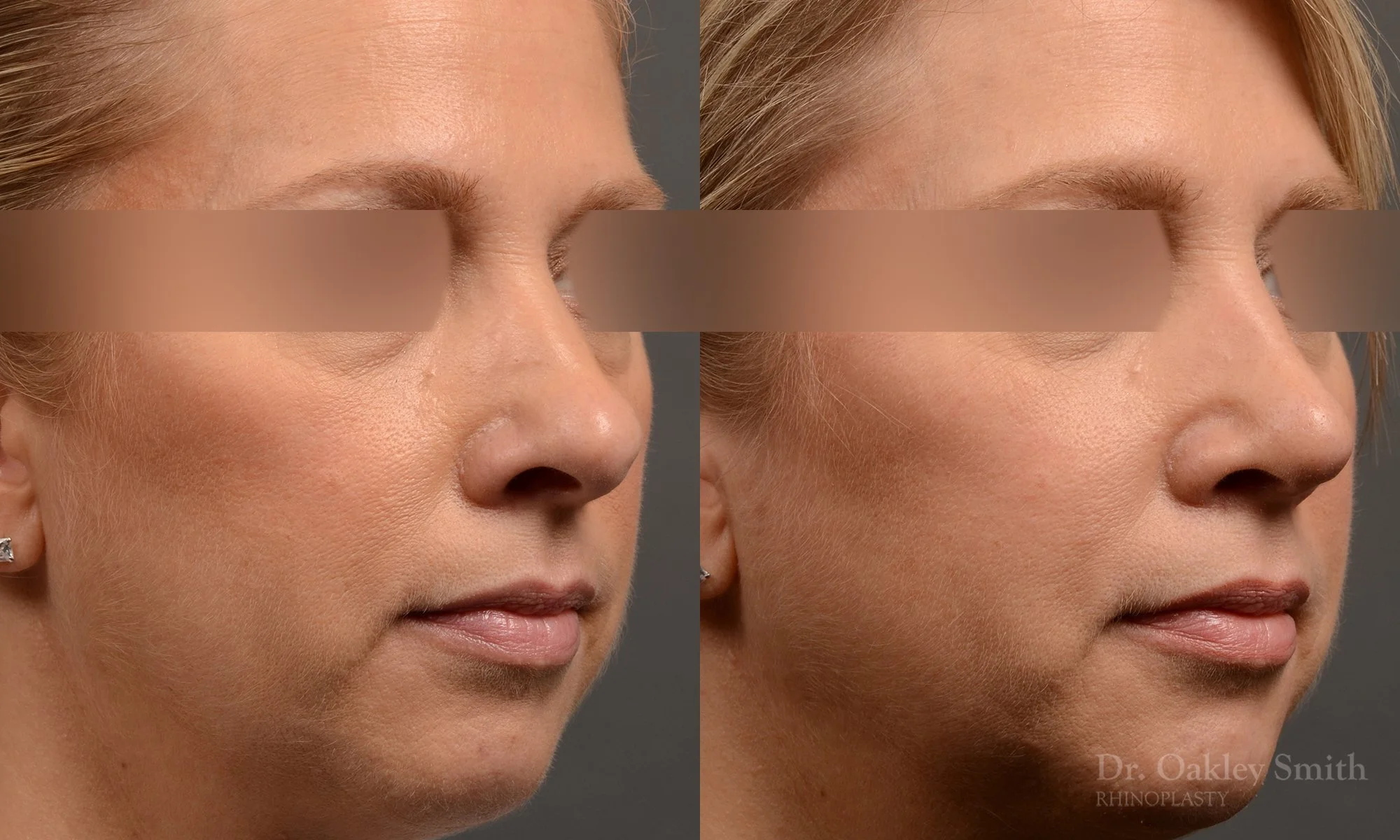 344B-rhinoplasty-dr-oakley-smith-toronto-nose-job-1.jpg
