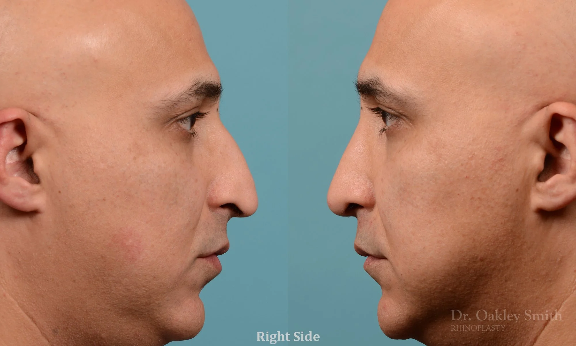 349.1C-rhinoplasty-dr-oakley-smith-toronto-nose-job.jpg