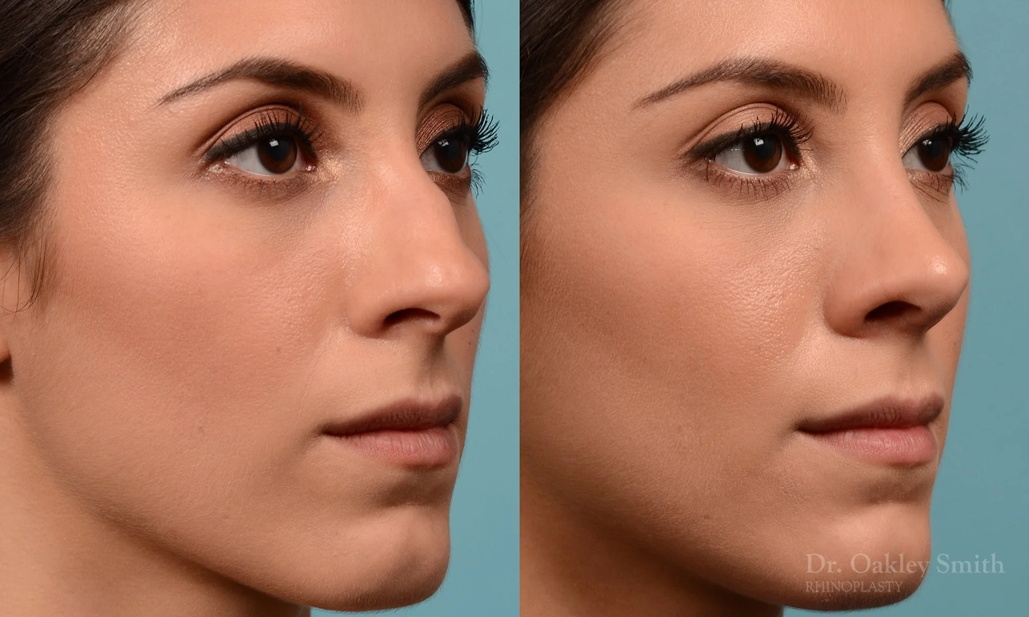 229B-rhinoplasty-oakley-smith-toronto-nose-job-straight-nose-bridge-1.jpg