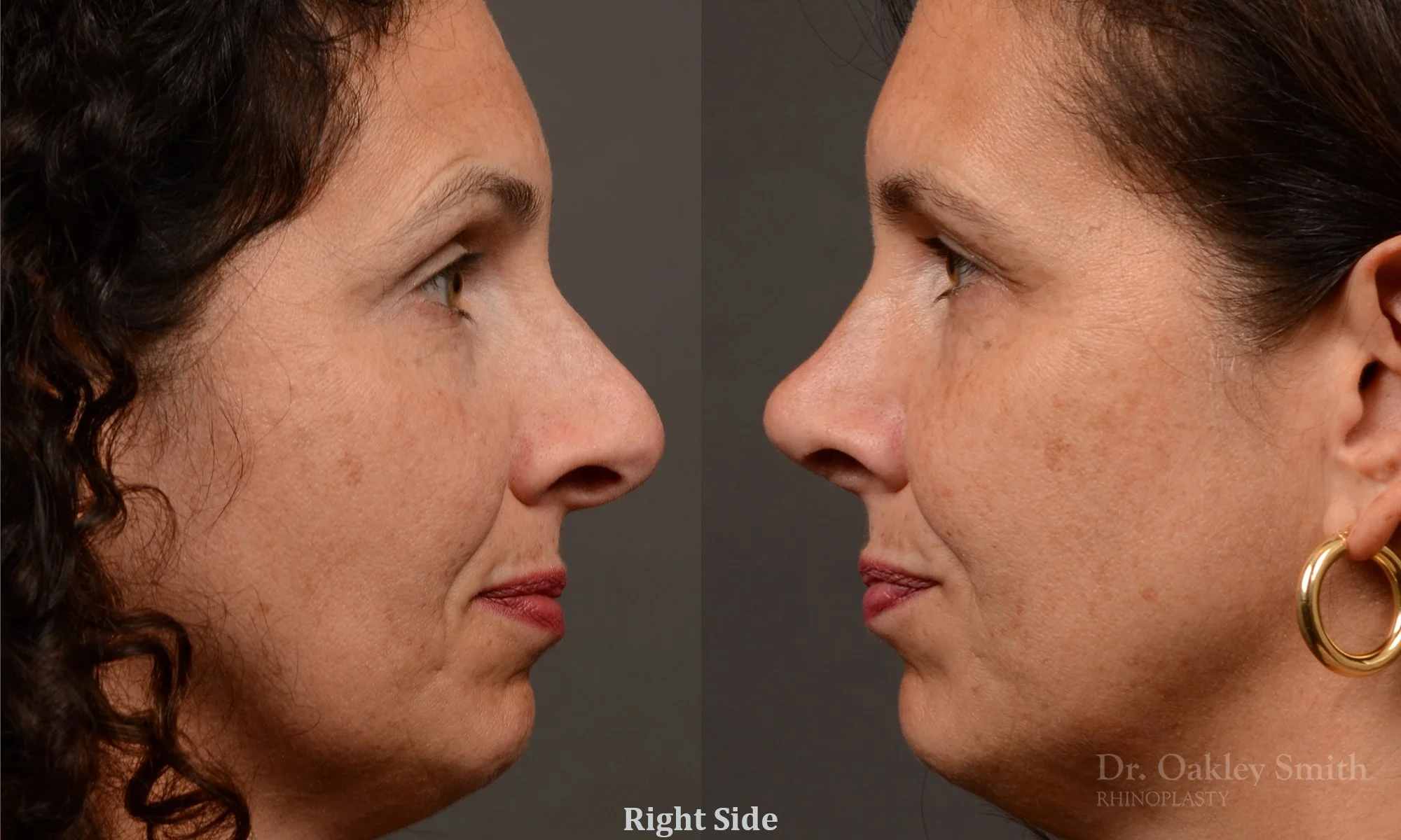 545:Female, Primary Rhinoplasty, Bridge and Tip Work, Crooked