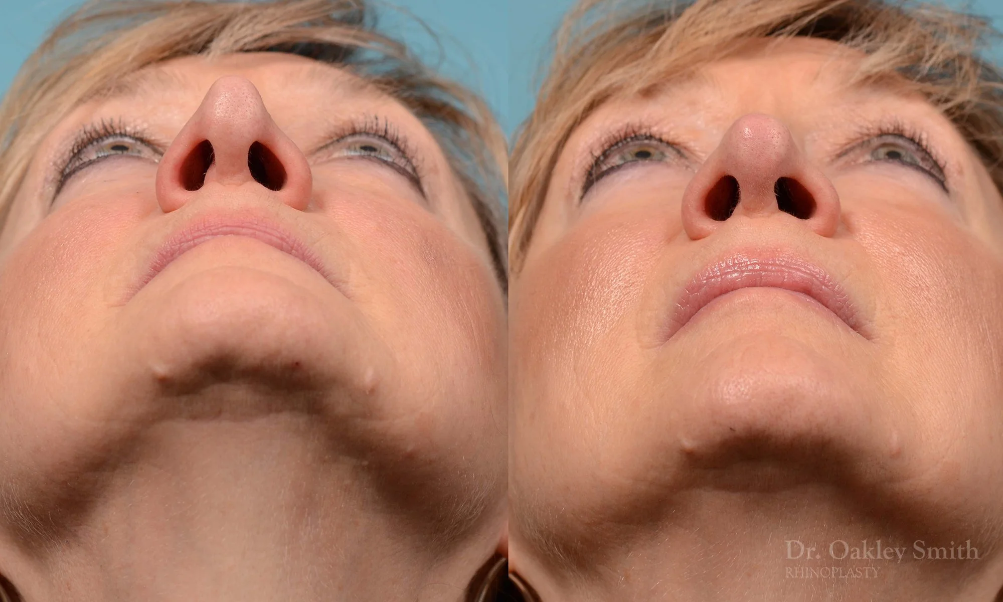 225F-rhinoplasty-dr-oakley-smith-nose-job-curved-nose-columellar-long-nose-1.jpg
