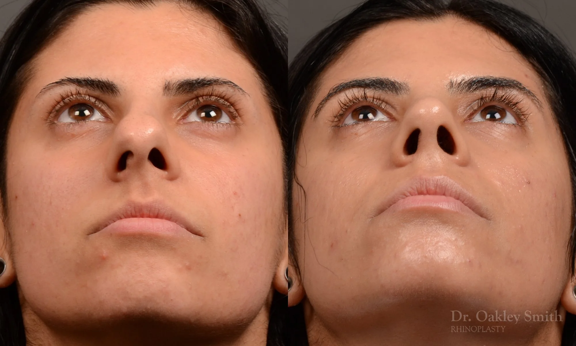 518F-rhinoplasty-dr-oakley-smith-toronto-top-surgeon-nose-job.jpg
