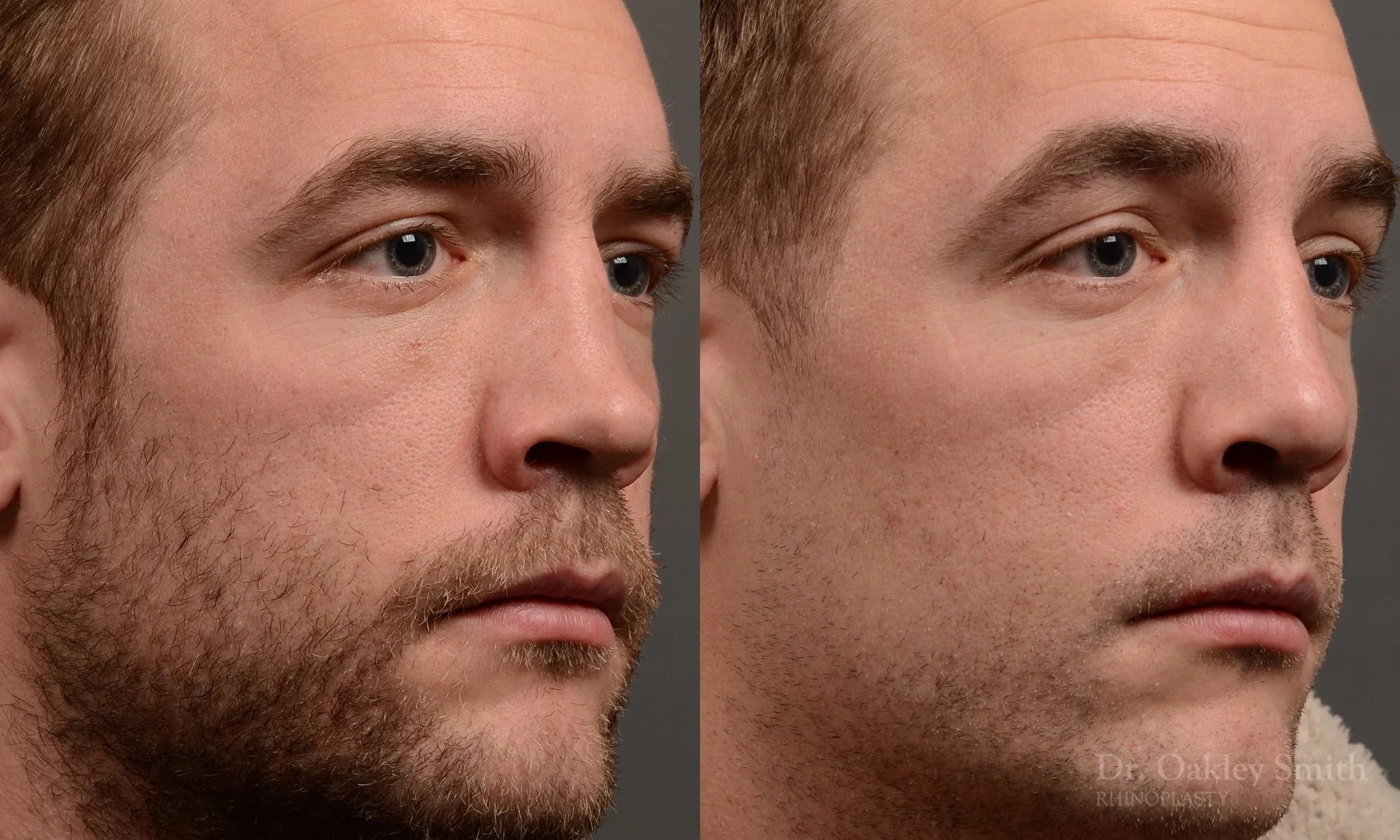 388B-rhinoplasty-dr-oakley-smith-toronto-nose-job.jpg