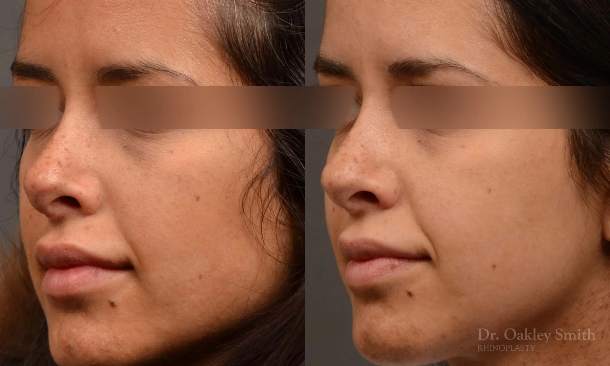 492D-rhinoplasty-dr-oakley-smith-toronto-top-surgeon-nose-job.jpg