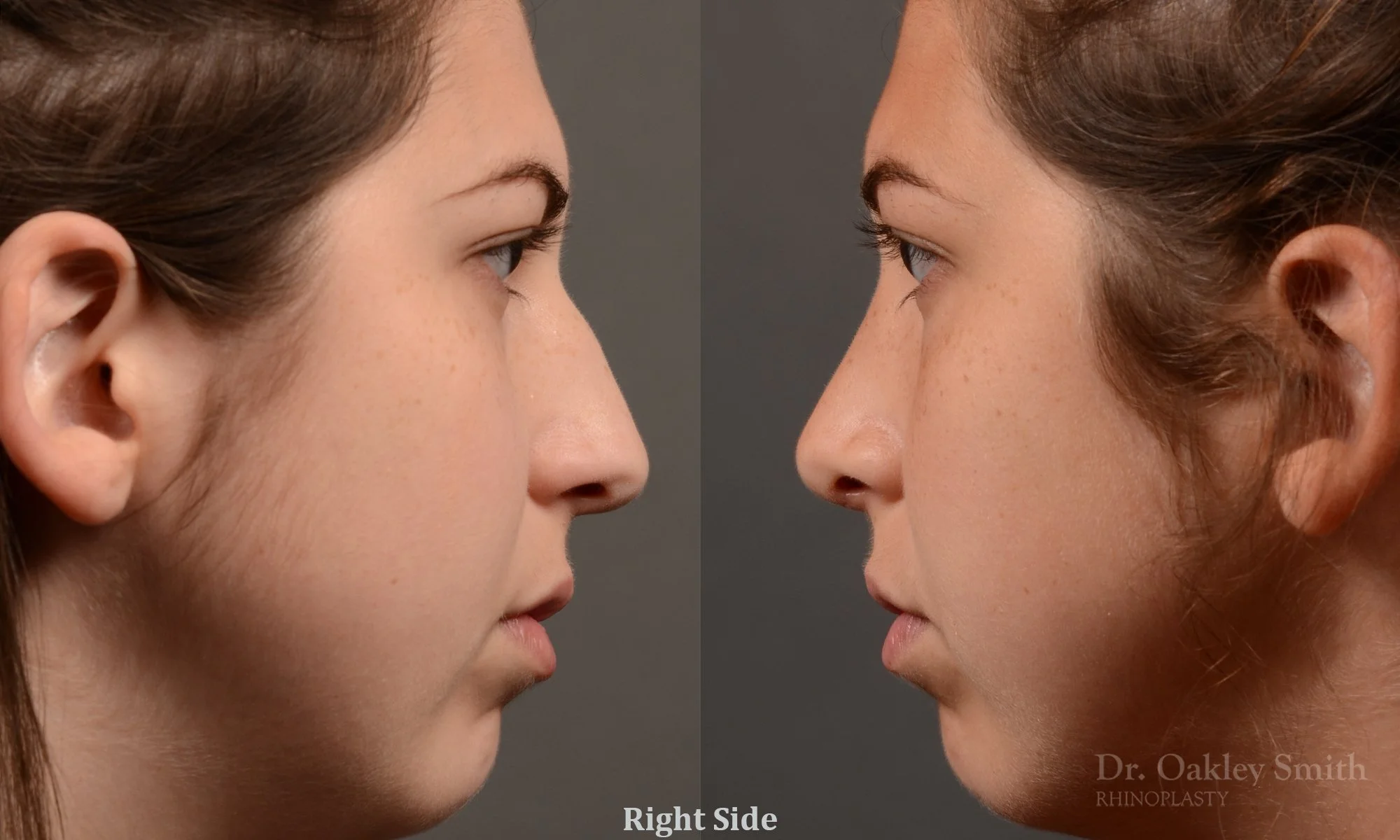 371C-rhinoplasty-dr-oakley-smith-toronto-nose-job.jpg