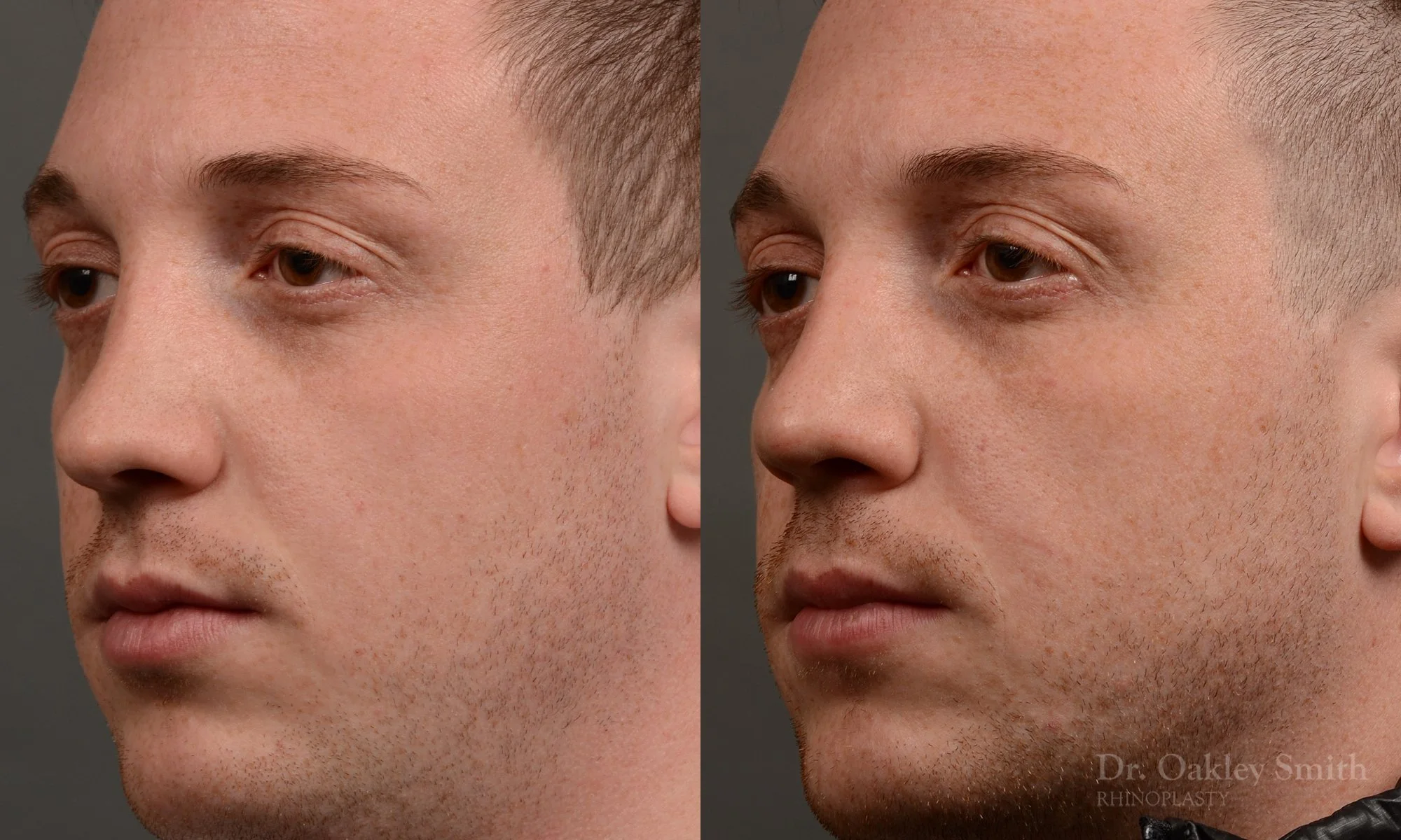 339.1D-rhinoplasty-dr-oakley-smith-toronto-male-nose-job.jpg