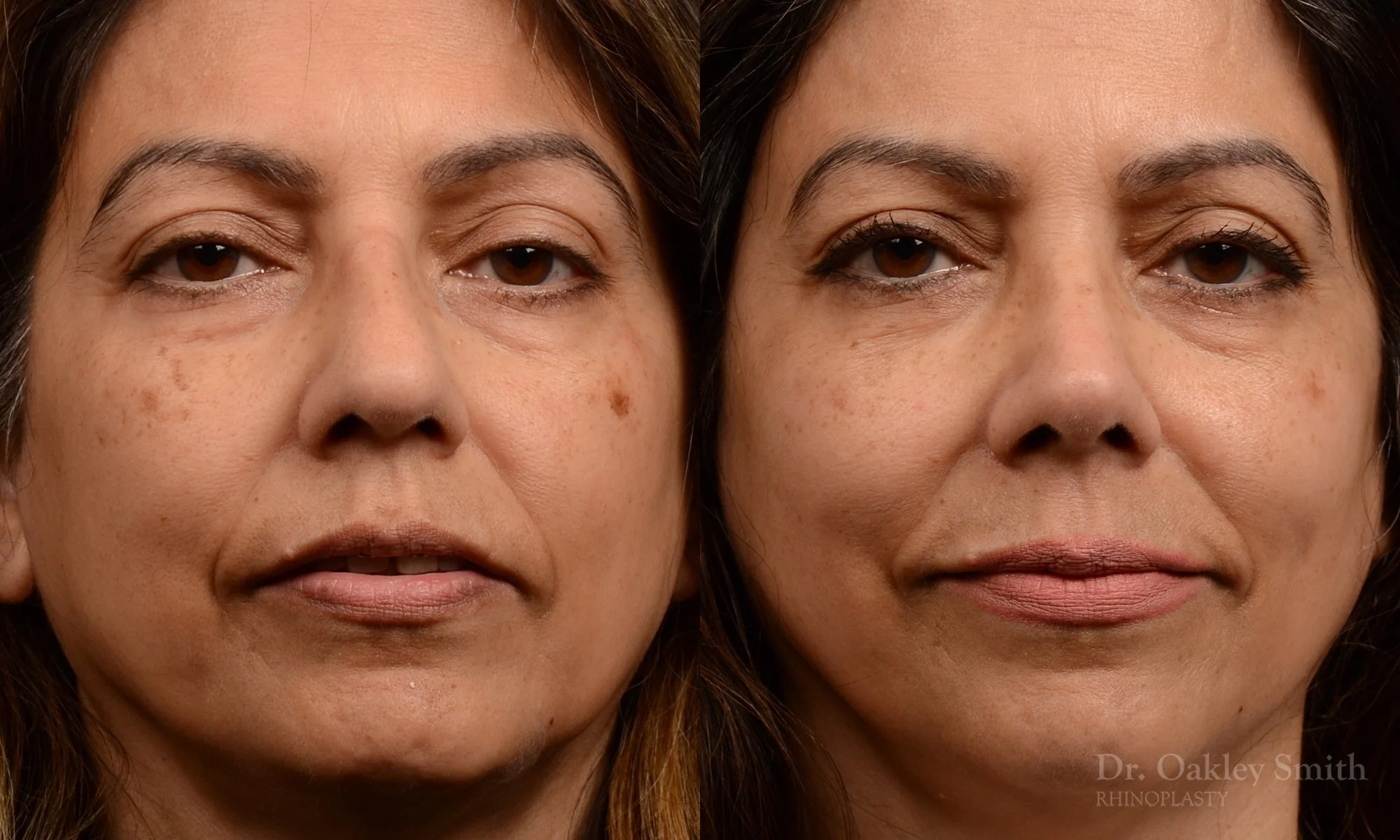 500A-rhinoplasty-dr-oakley-smith-toronto-top-surgeon-nose-job.jpg