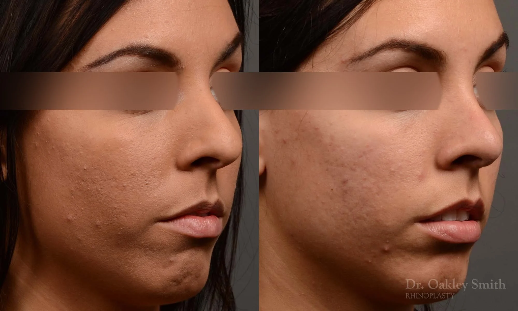 320B-rhinoplasty-dr-oakley-smith-toronto-nose-job.jpg