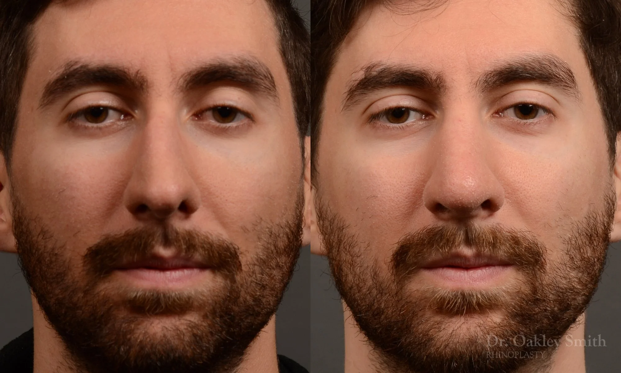 469A-rhinoplasty-dr-oakley-smith-toronto-top-surgeon-nose-job.jpg