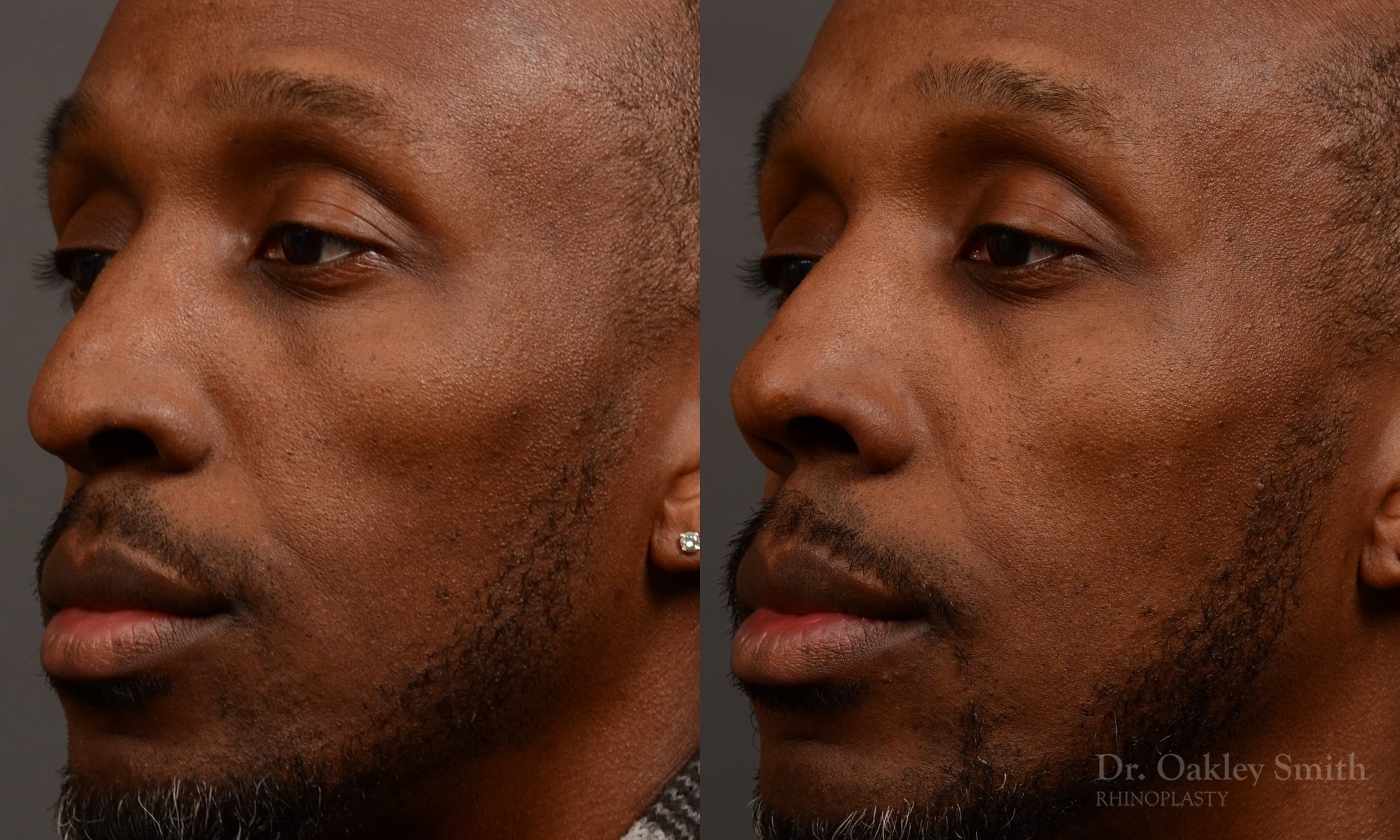 504D-malerhinoplasty-dr-oakley-smith-toronto-top-surgeon-nose-job.jpg