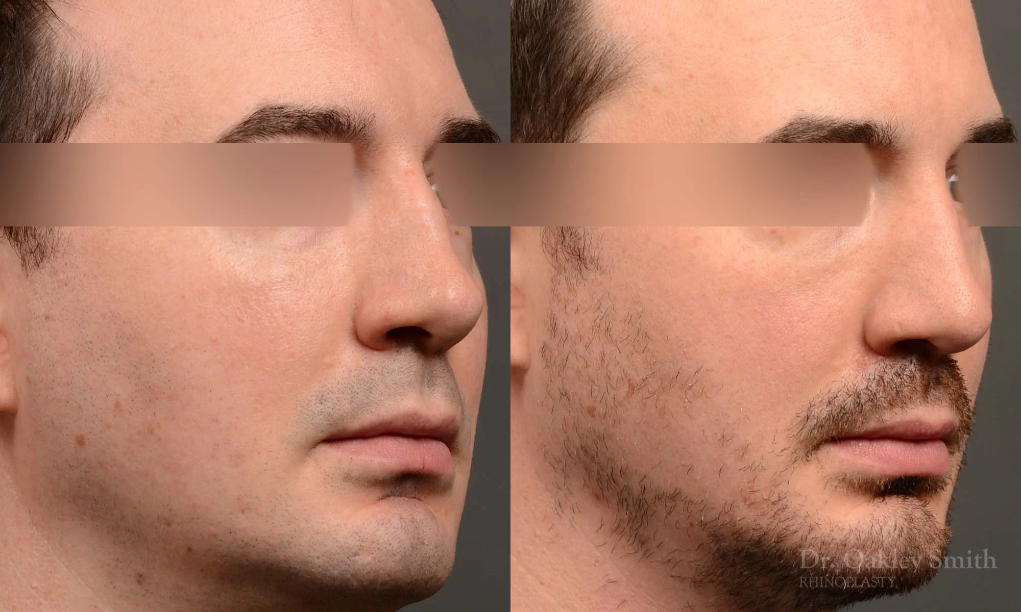 555B male rhinoplasty, nose job, toronto nose surgeon, dr oakley smith.jpg