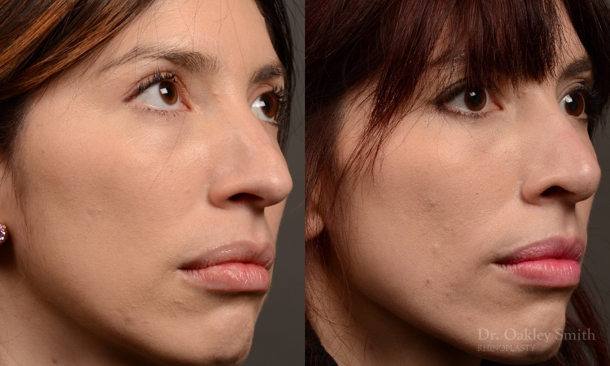 525B-rhinoplasty-dr-oakley-smith-toronto-top-surgeon-nose-job.jpg