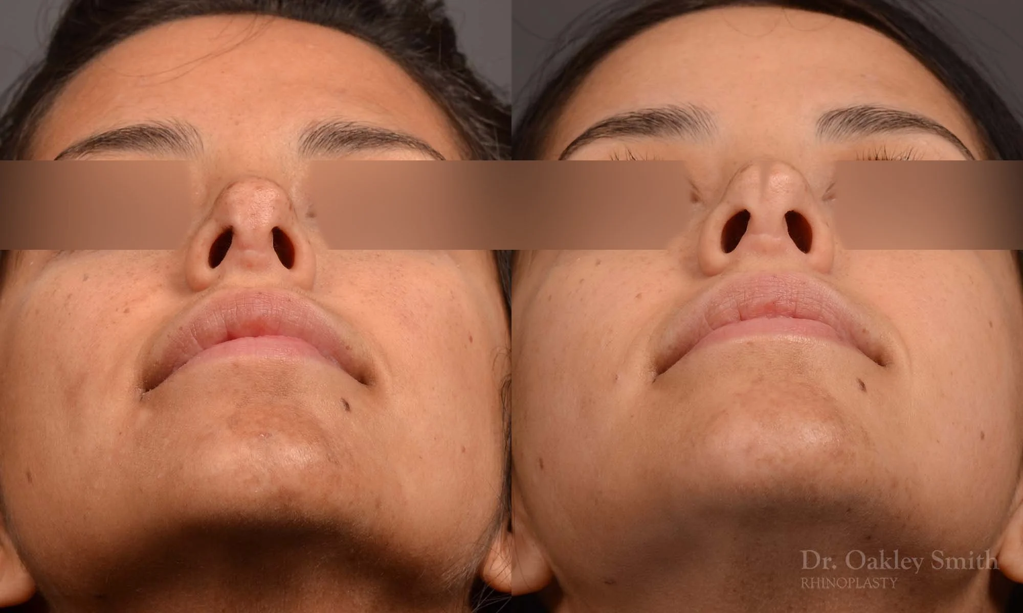 492F-rhinoplasty-dr-oakley-smith-toronto-top-surgeon-nose-job.jpg