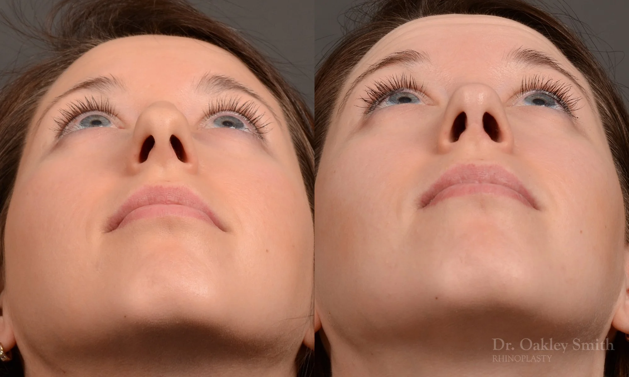 516F-rhinoplasty-dr-oakley-smith-toronto-top-surgeon-nose-job.jpg