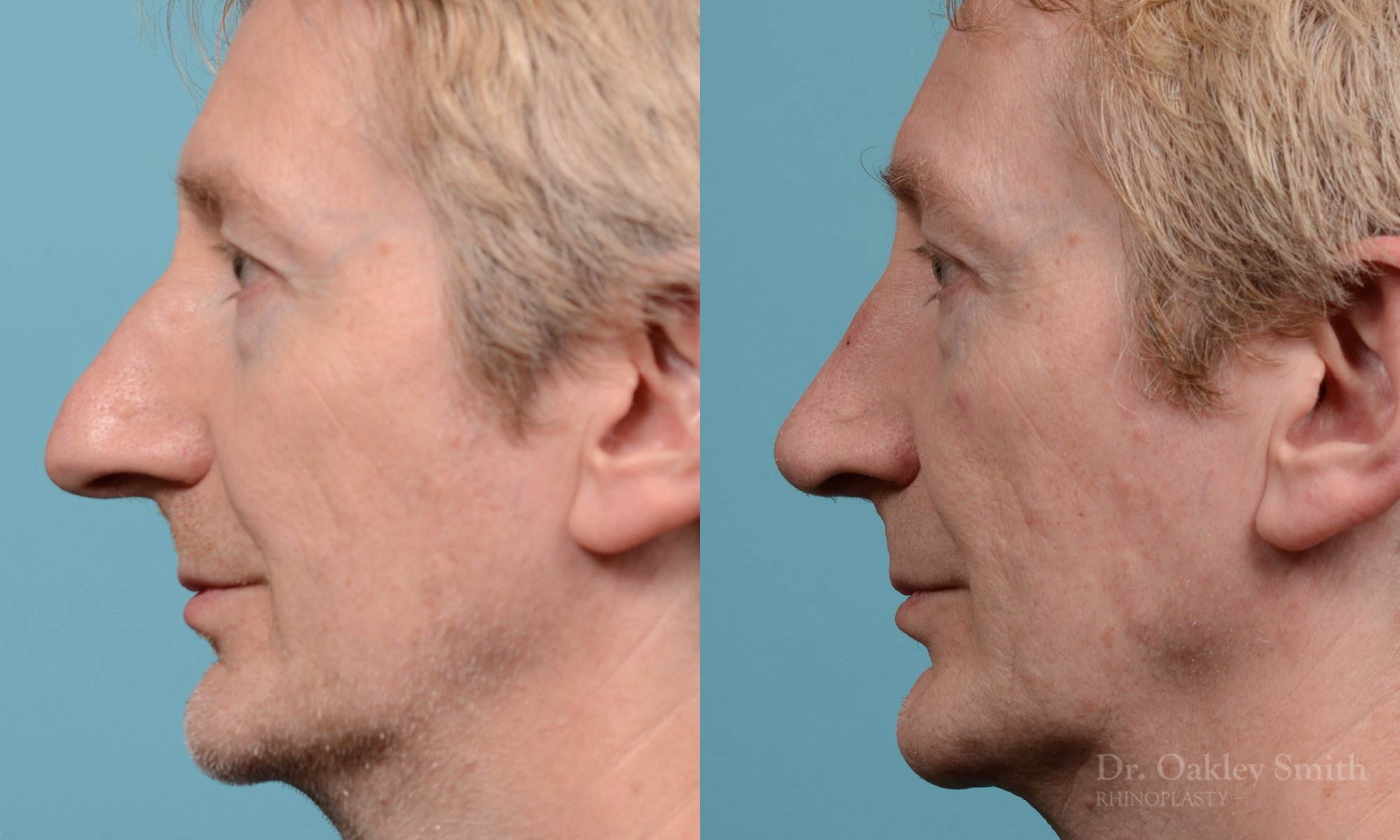 276E-rhinoplasty-dr-oakley-smith-toronot-nose-job.jpg