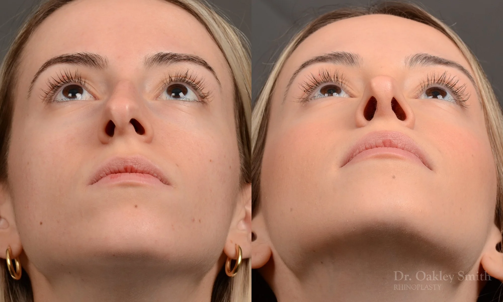 531F-rhinoplasty-dr-oakley-smith-toronto-top-surgeon-nose-job.jpg
