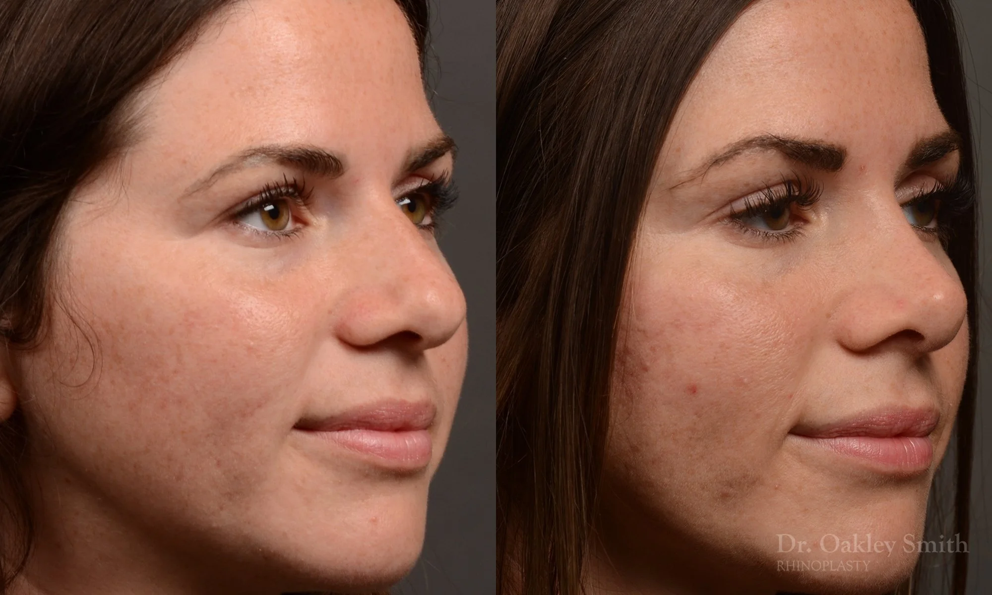 481B-rhinoplasty-dr-oakley-smith-toronto-top-surgeon-nose-job.jpg