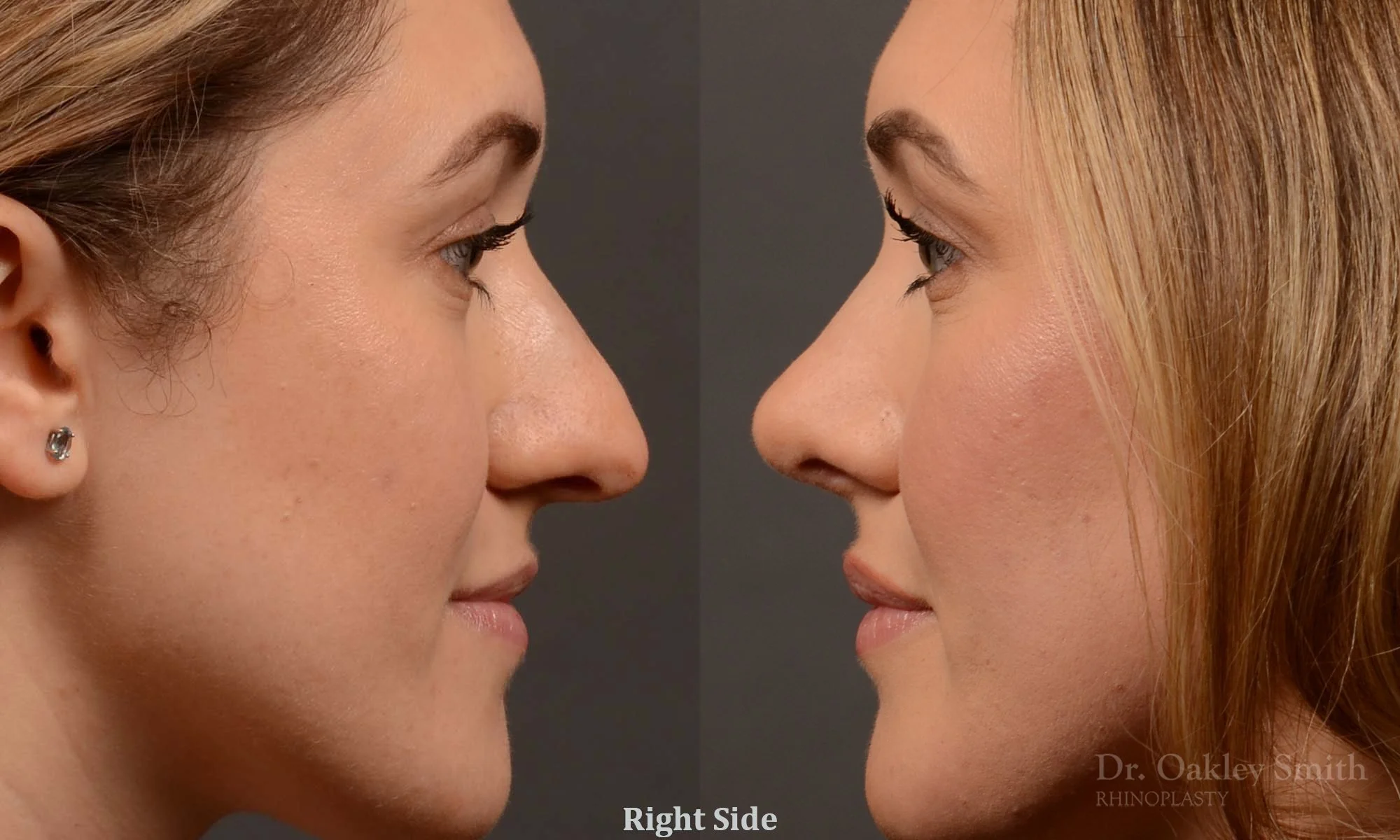 497: Female, Primary  Rhinoplasty, Normal Skin, Bridge Work, Tip Work