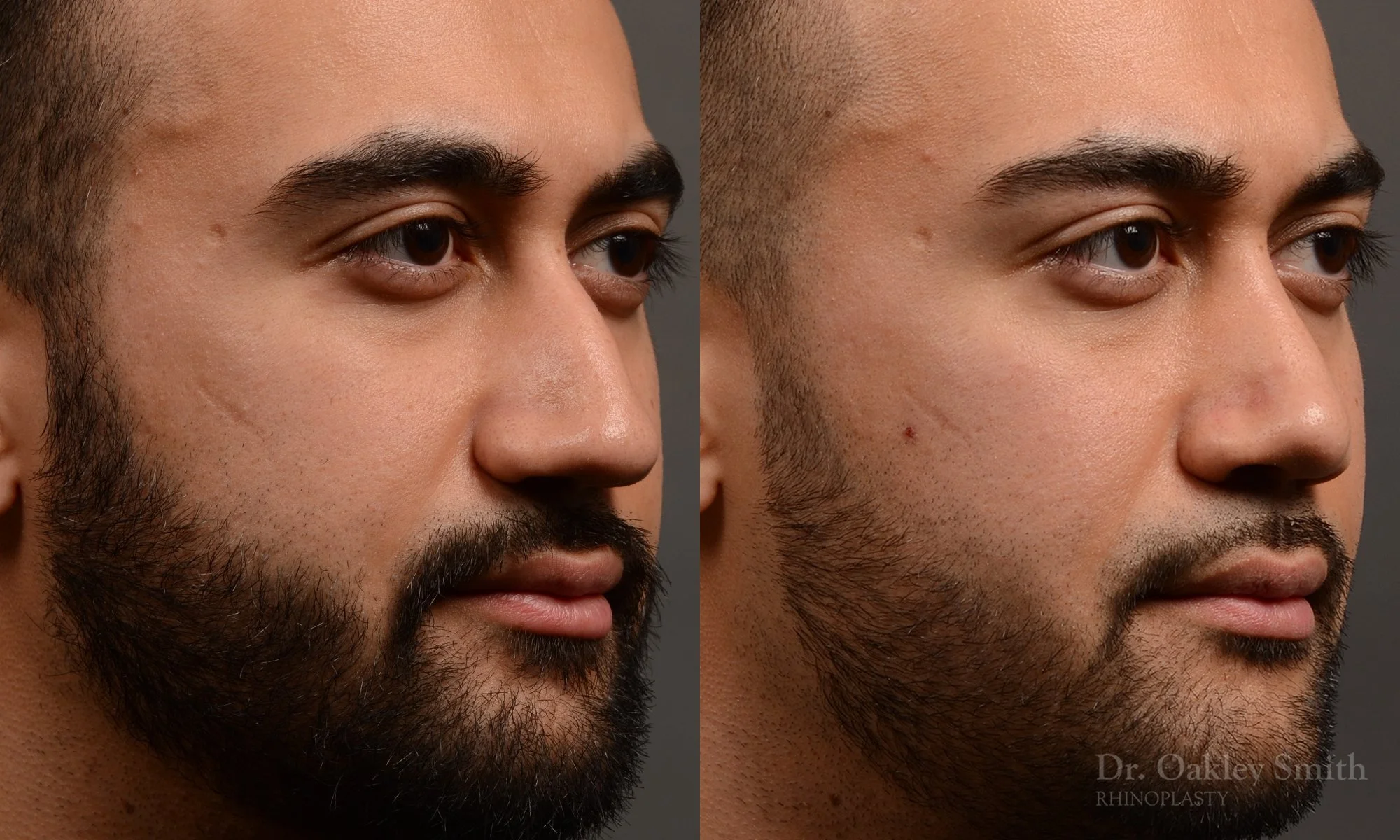 362.1B-rhinoplasty-dr-oakley-smith-toronto-nose-job.jpg