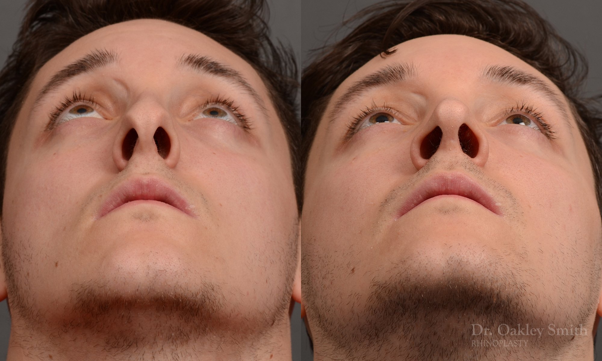 377.1F-rhinoplasty-dr-oakley-smith-toronto-nose-job.jpg