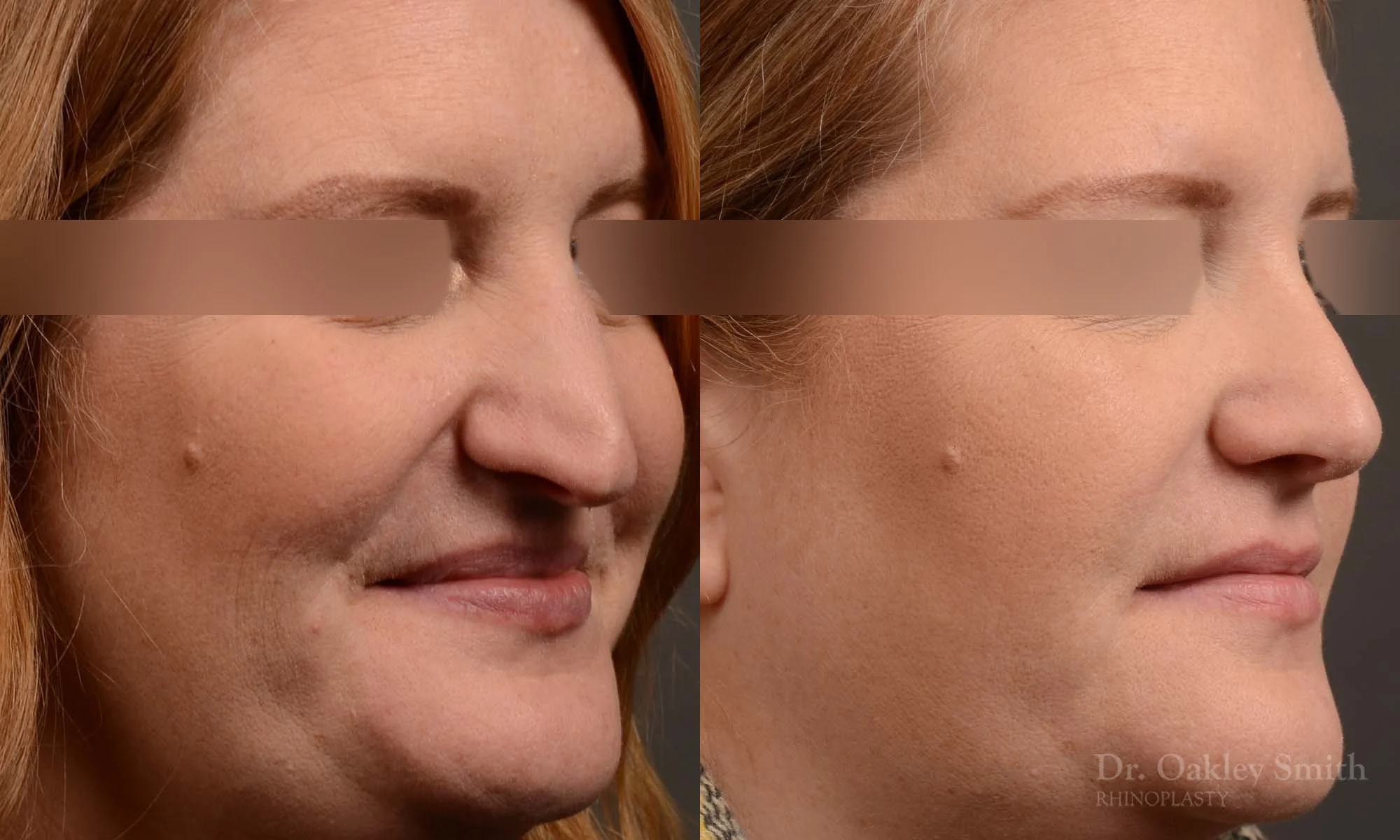489B-rhinoplasty-dr-oakley-smith-toronto-top-surgeon-nose-job.jpg