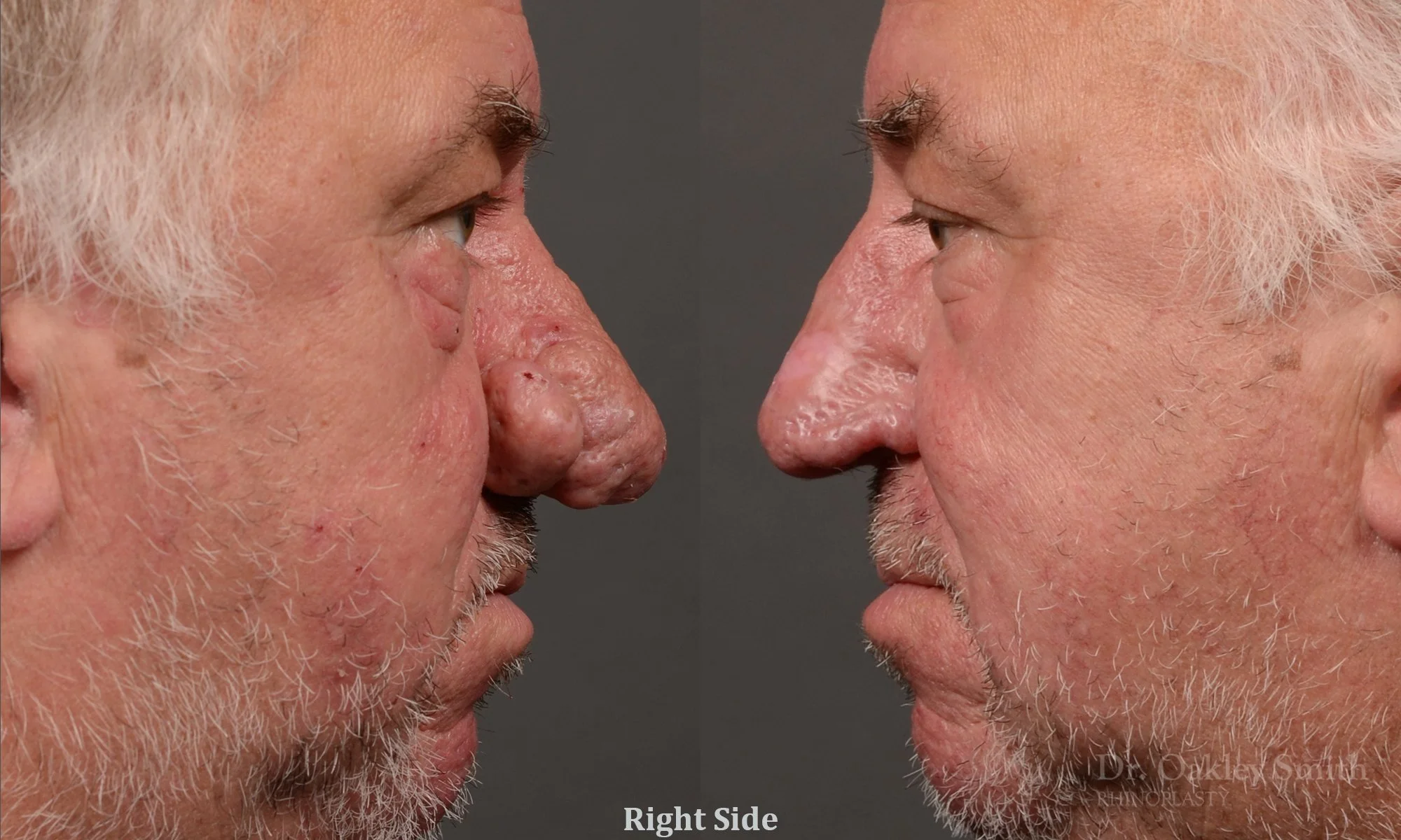 471C-rhinoplasty-septoplastry-dr-oakley-smith-toronto-top-surgeon-nose-job.jpg